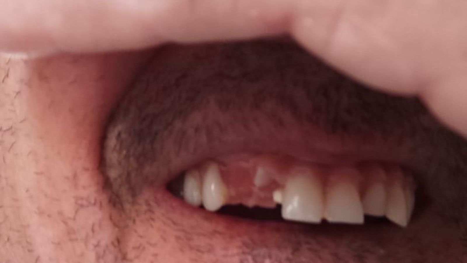 La víctima muestra el estado de su dentadura tras ser tratado por la detenida de Dentaluz. La víctima muestra el estado de su dentadura tras ser tratado por la detenida de Dentaluz.