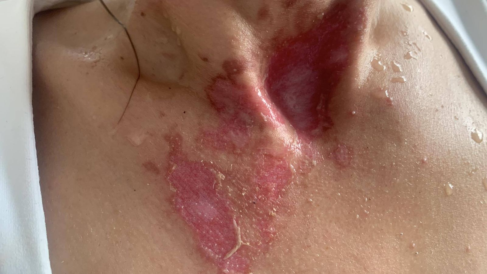 Quemadura 2º grado provocada por café hirviendo