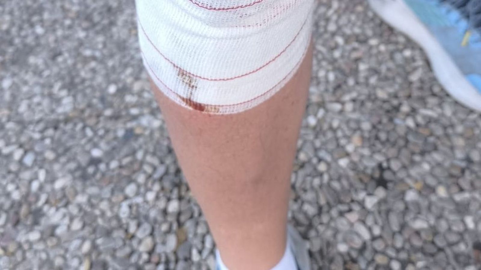 El policía, con una pierna vendada