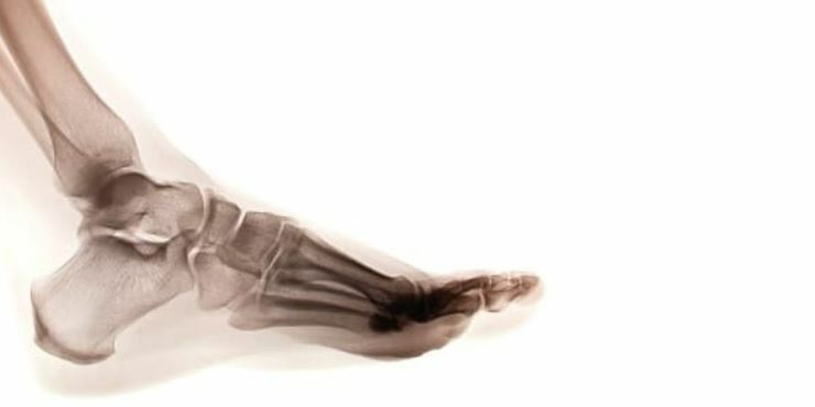 Radiografía de un pie, articulación lesionado en Pau Gasol.