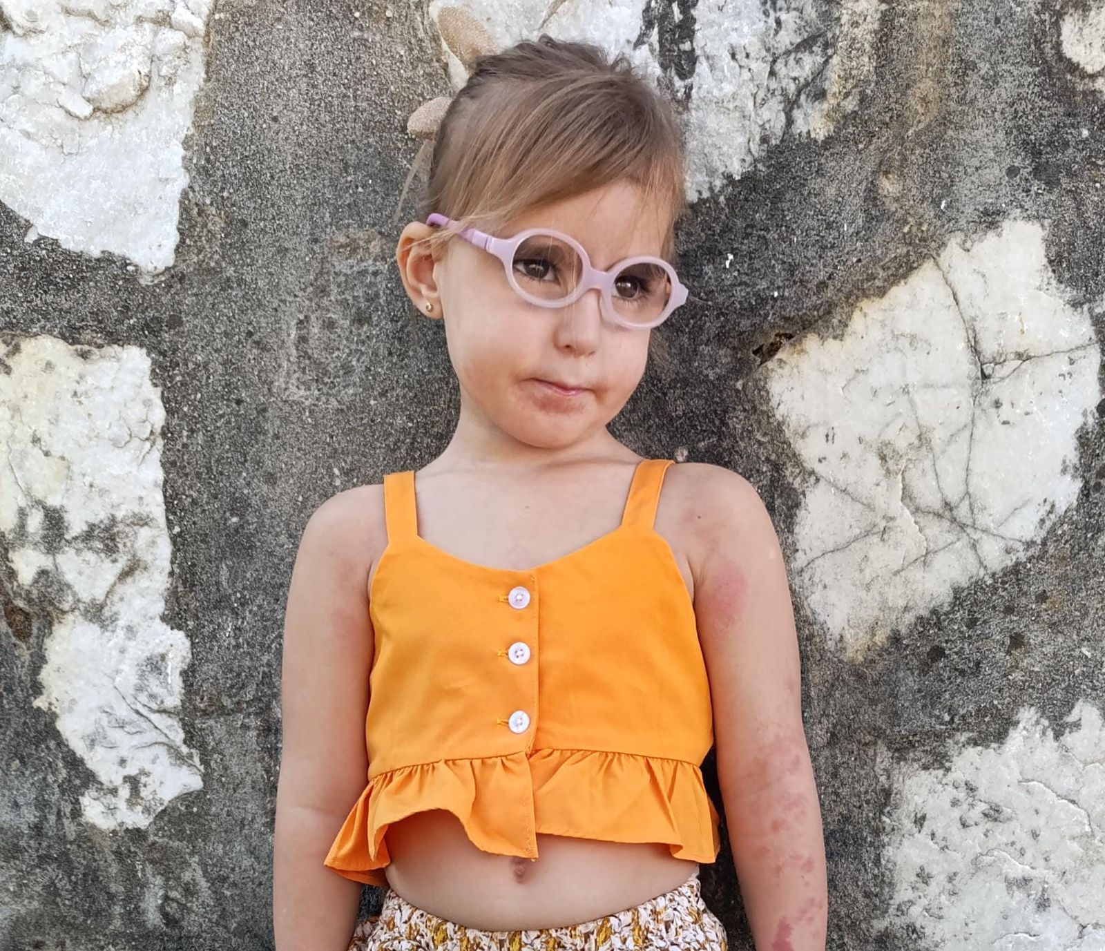 Ángela, la niña de cuatro años con una enfermedad ultrarrara, DYRK1A, la única de Málaga.