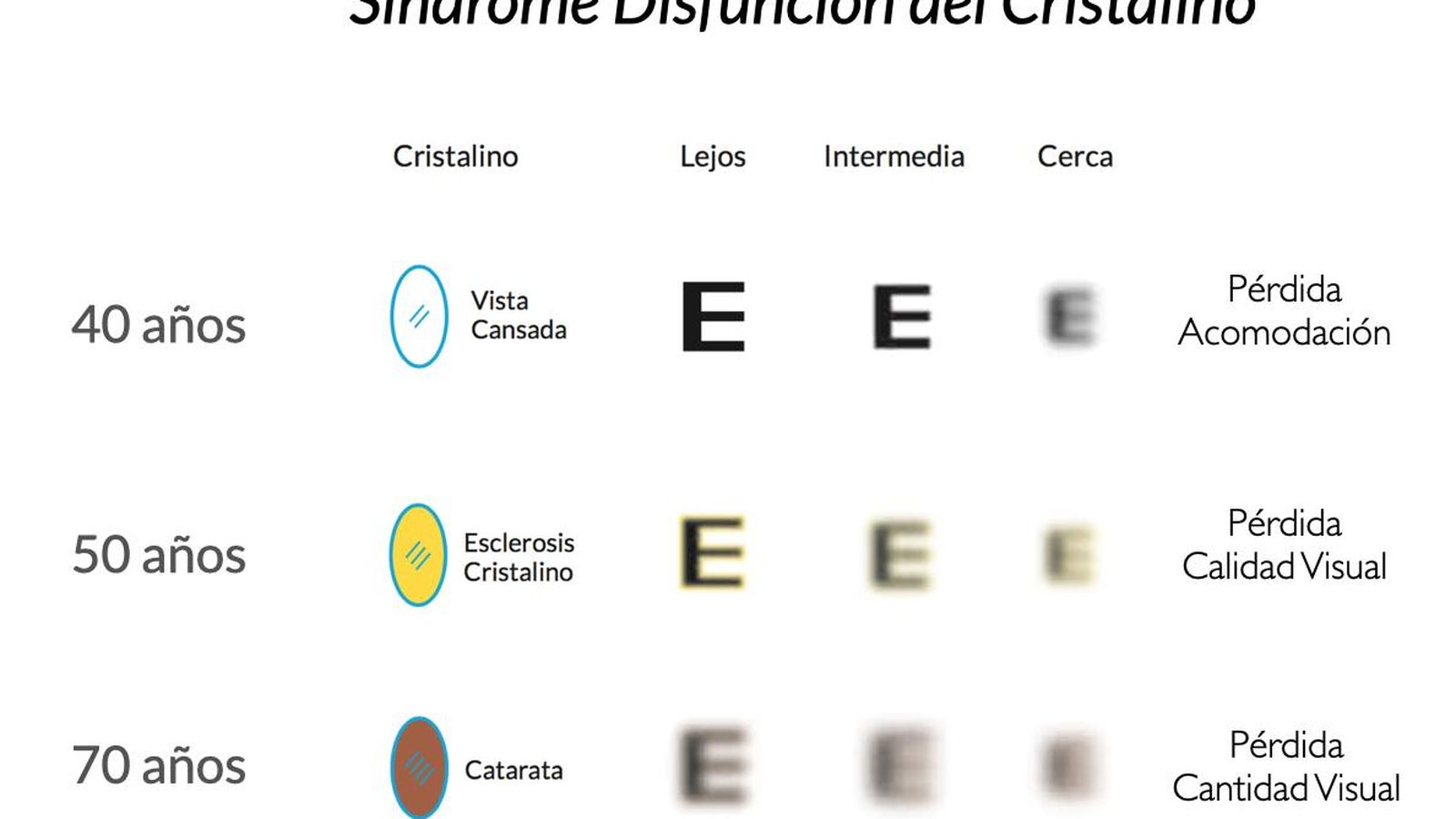 Síndrome Disfunción del Cristalino