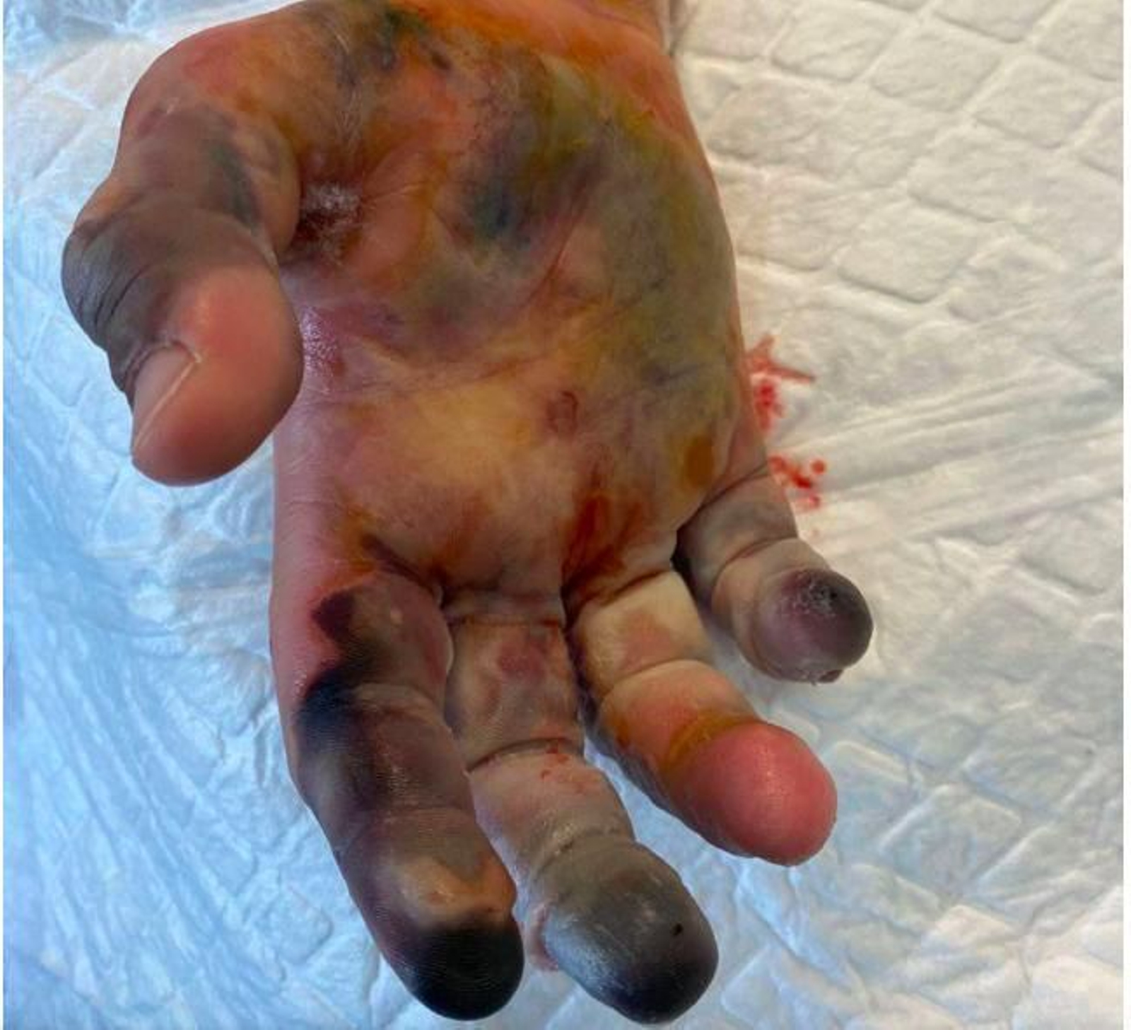 Mano del hombre atacado por araña