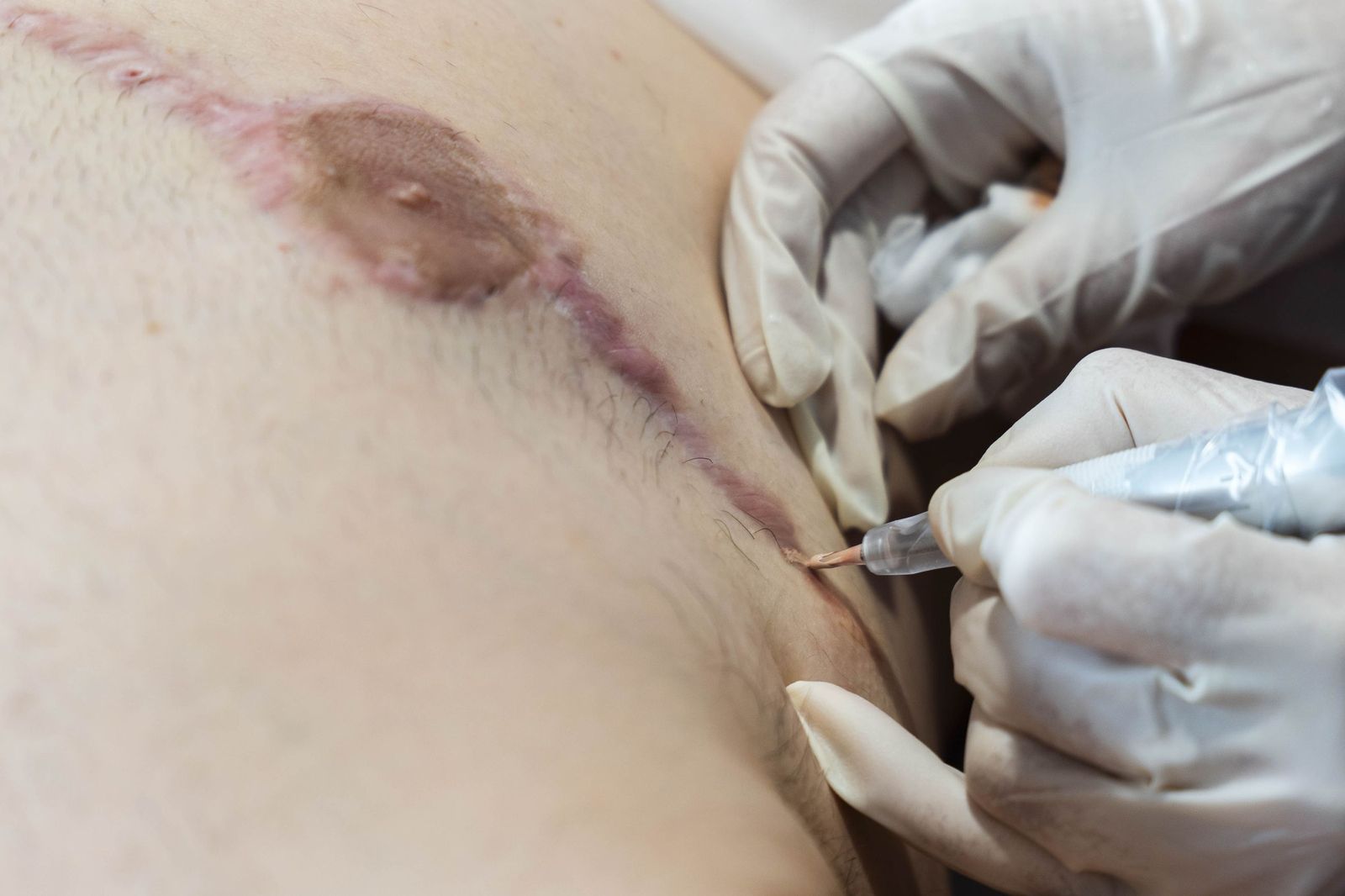 Un tratamiento de micropigmentación por mastectomía en un hombre, en imágenes