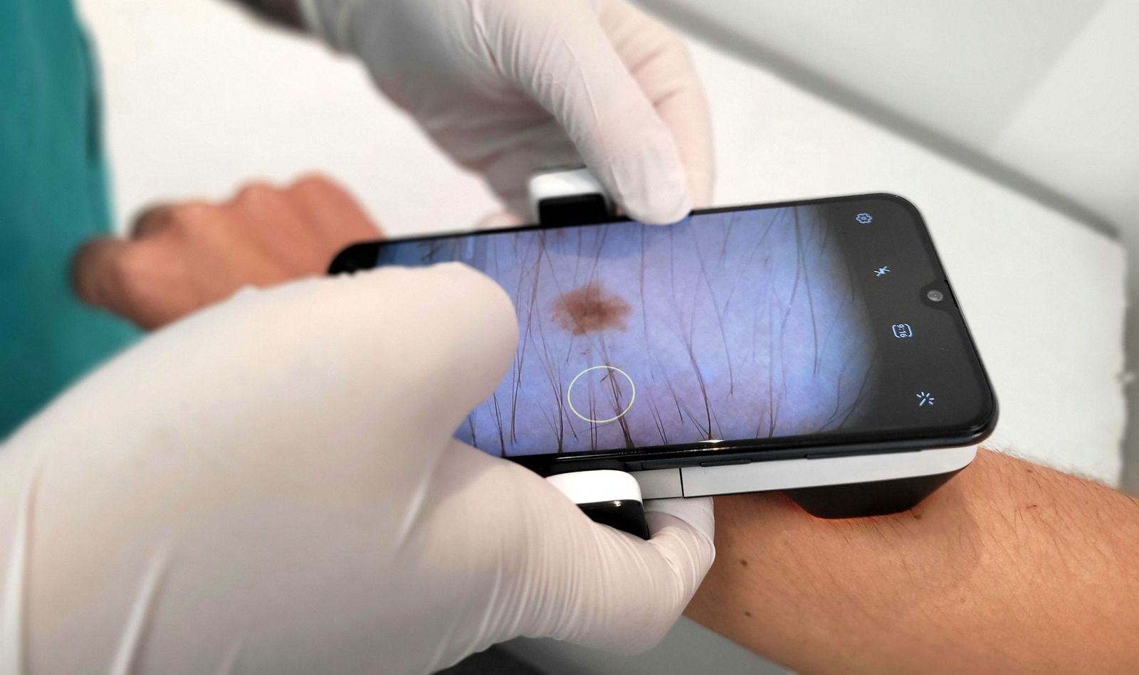 Un dermatoscopio de teledermatología.