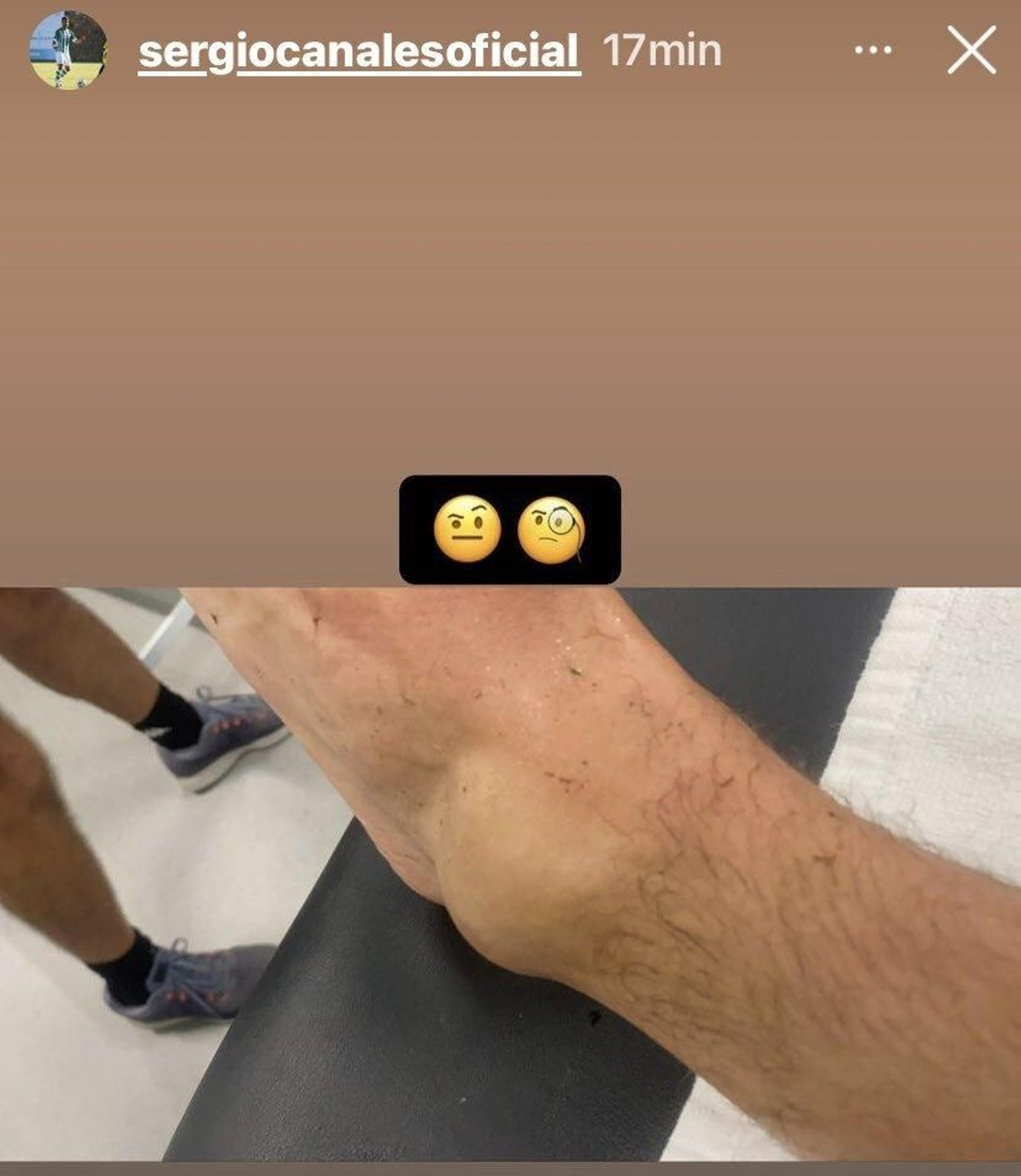 Así quedó el tobillo de Canales.