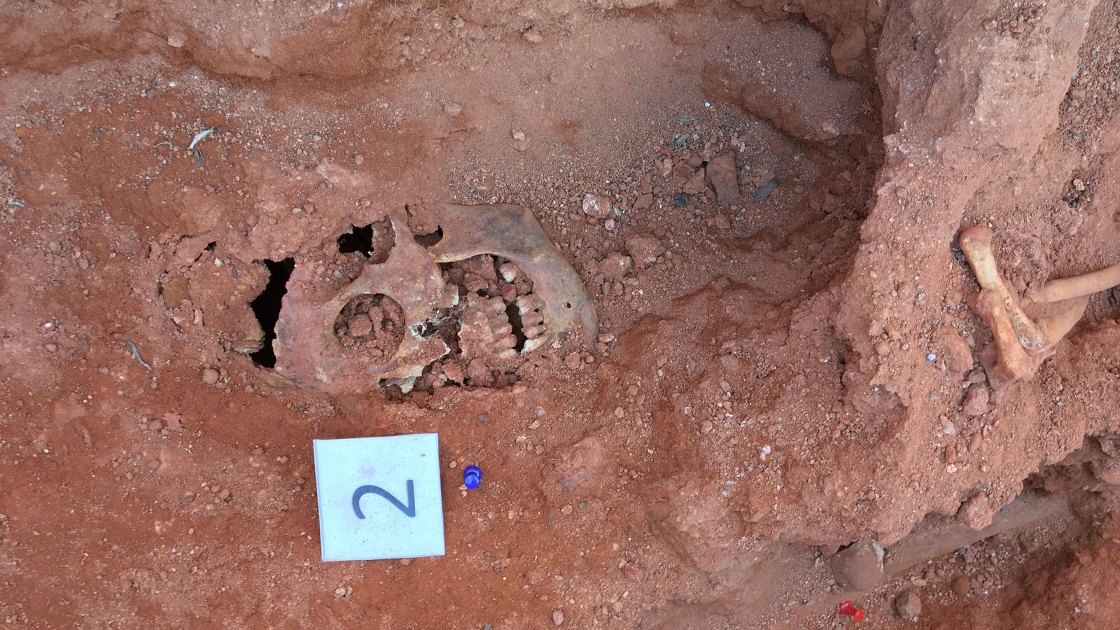 Craneo hallado en la fosa 86 con orificio de salida de proyectil por la parte frontal.