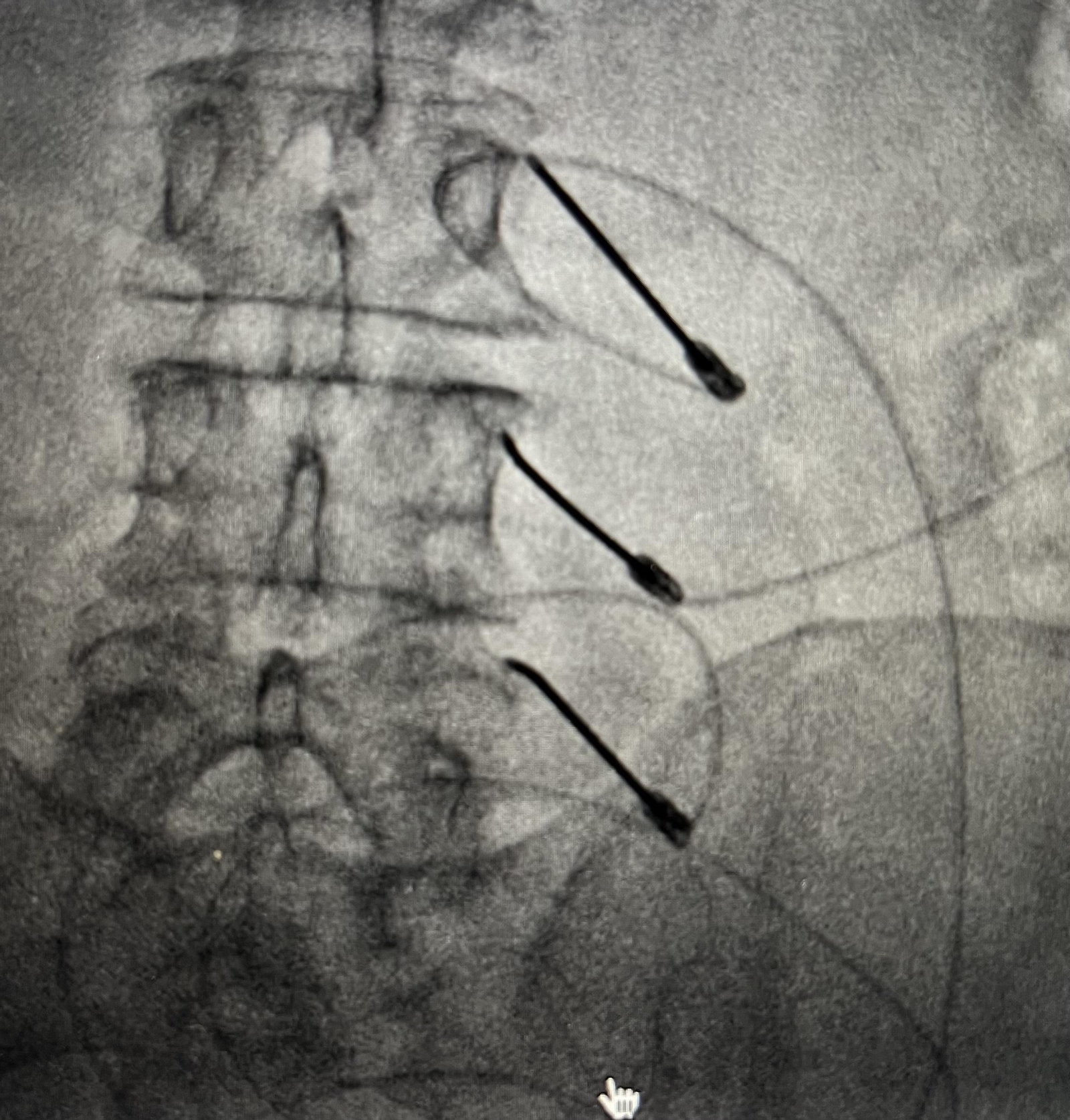 La Rizolisis lumbar es uno de los mejores tratamientos para esta zona del cuerpo.