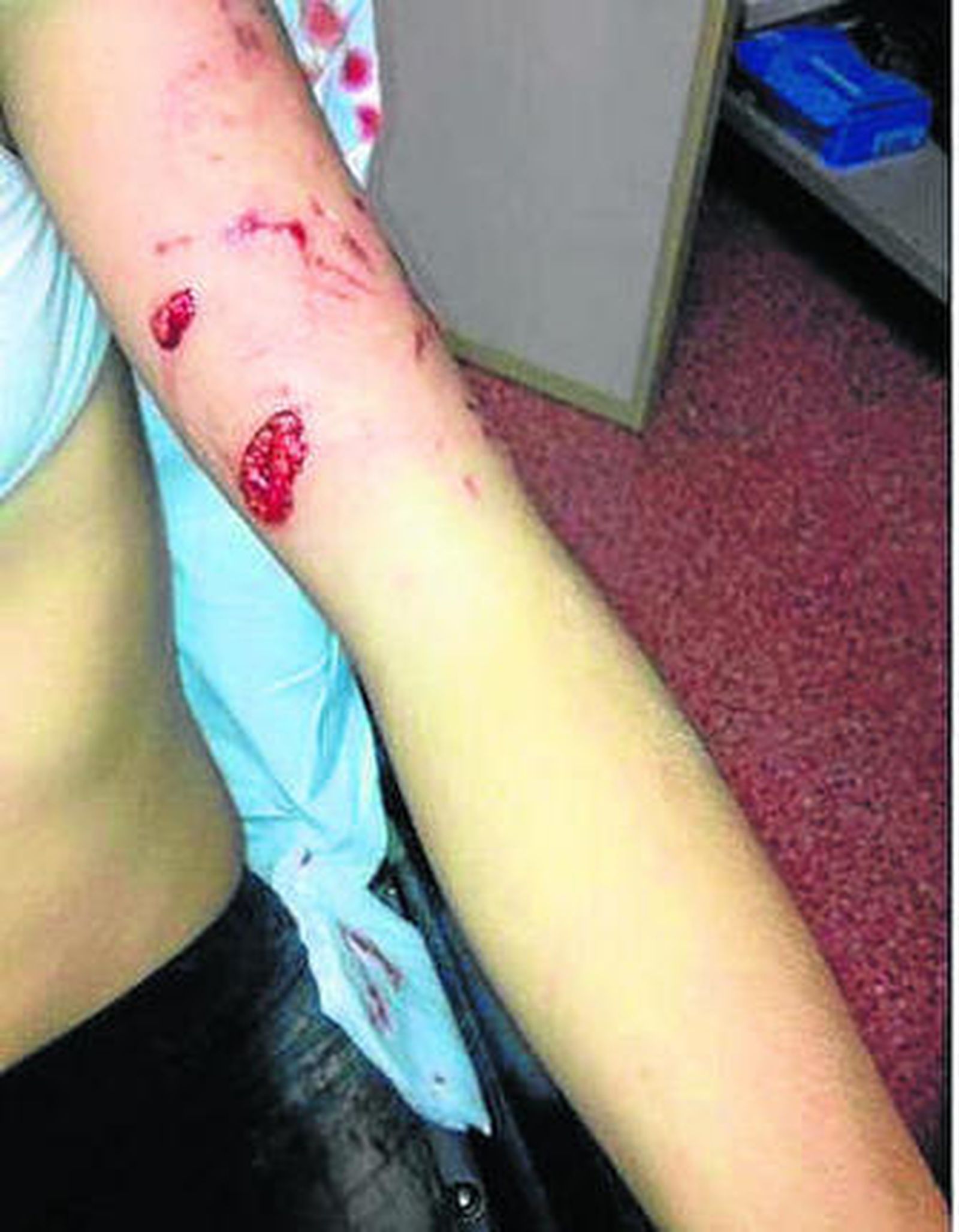 Imagen de las heridas sufridas por la pequeña el pasado día 22.