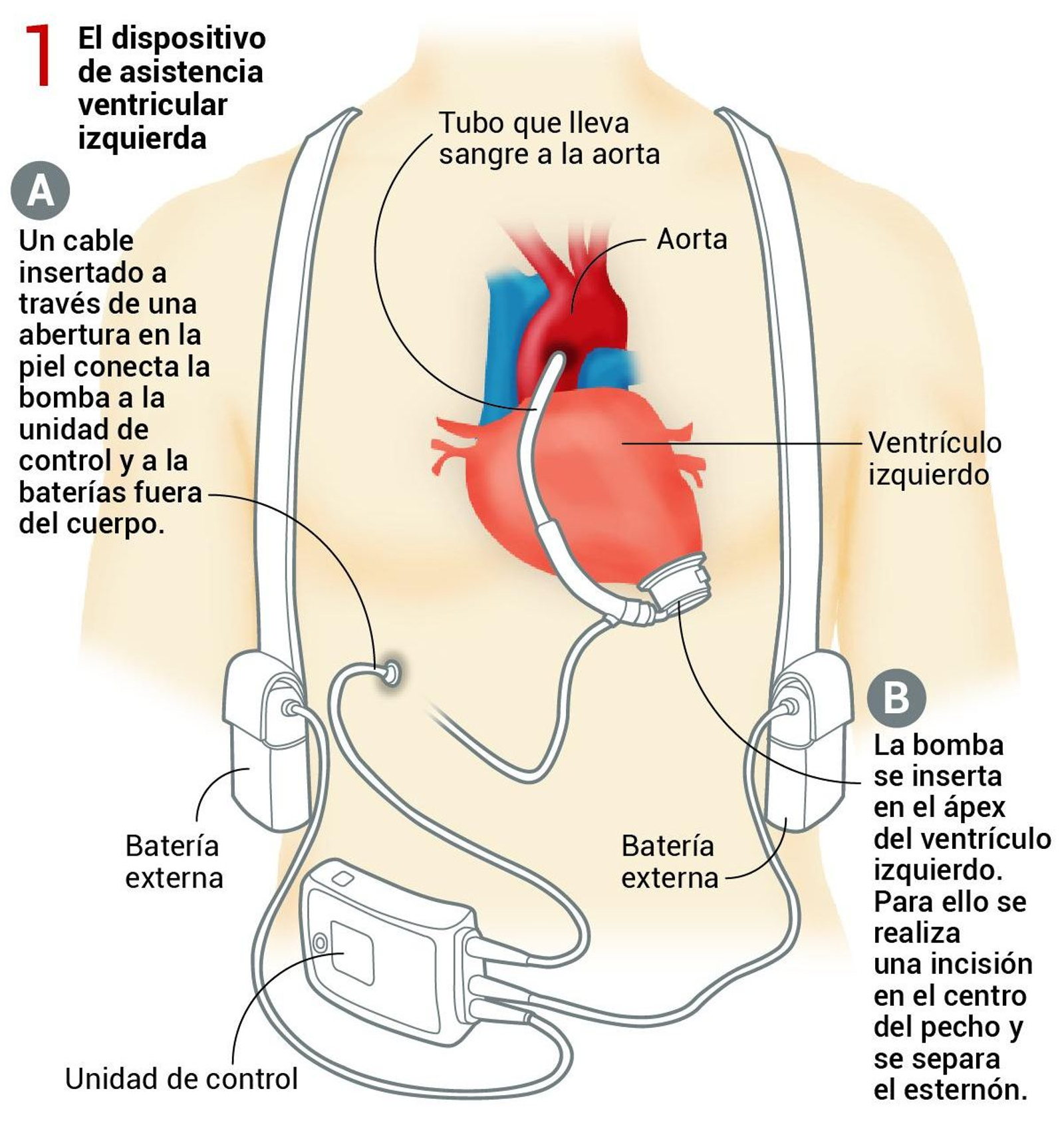 El dispositivo de asistencia ventricular colocado en el paciente