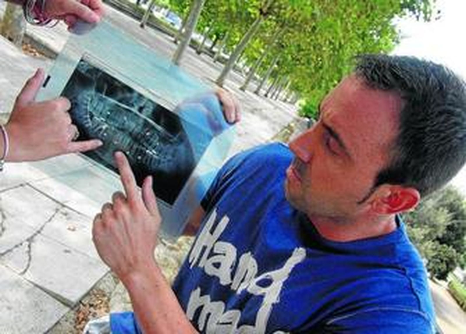 El portuense Efrén V. muestra en una radiografía las lesiones provocadas por la agresión que sufrió a manos de porteros de una discoteca en Conil.