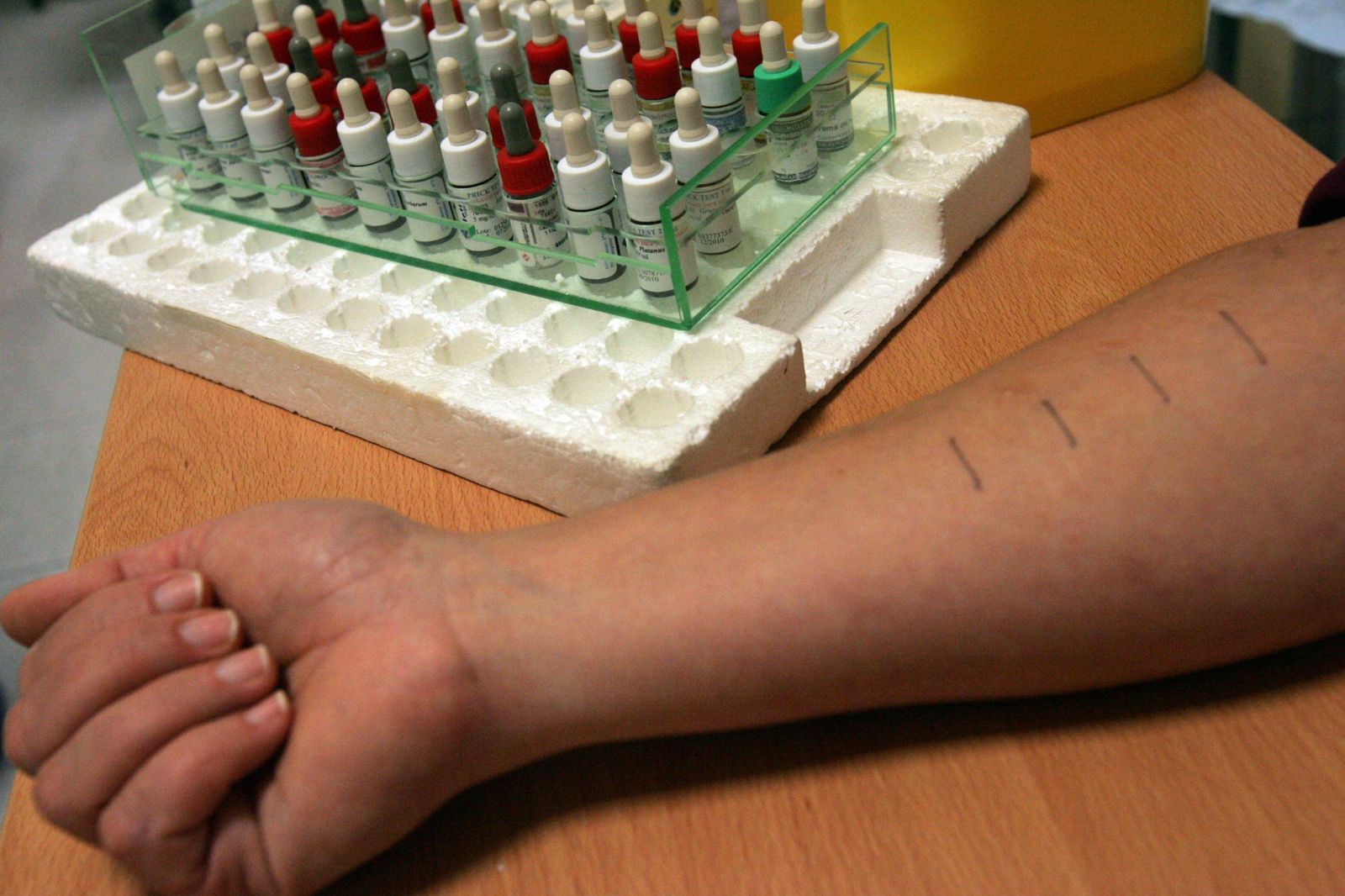 Una persona se somete a las pruebas de la alergia.