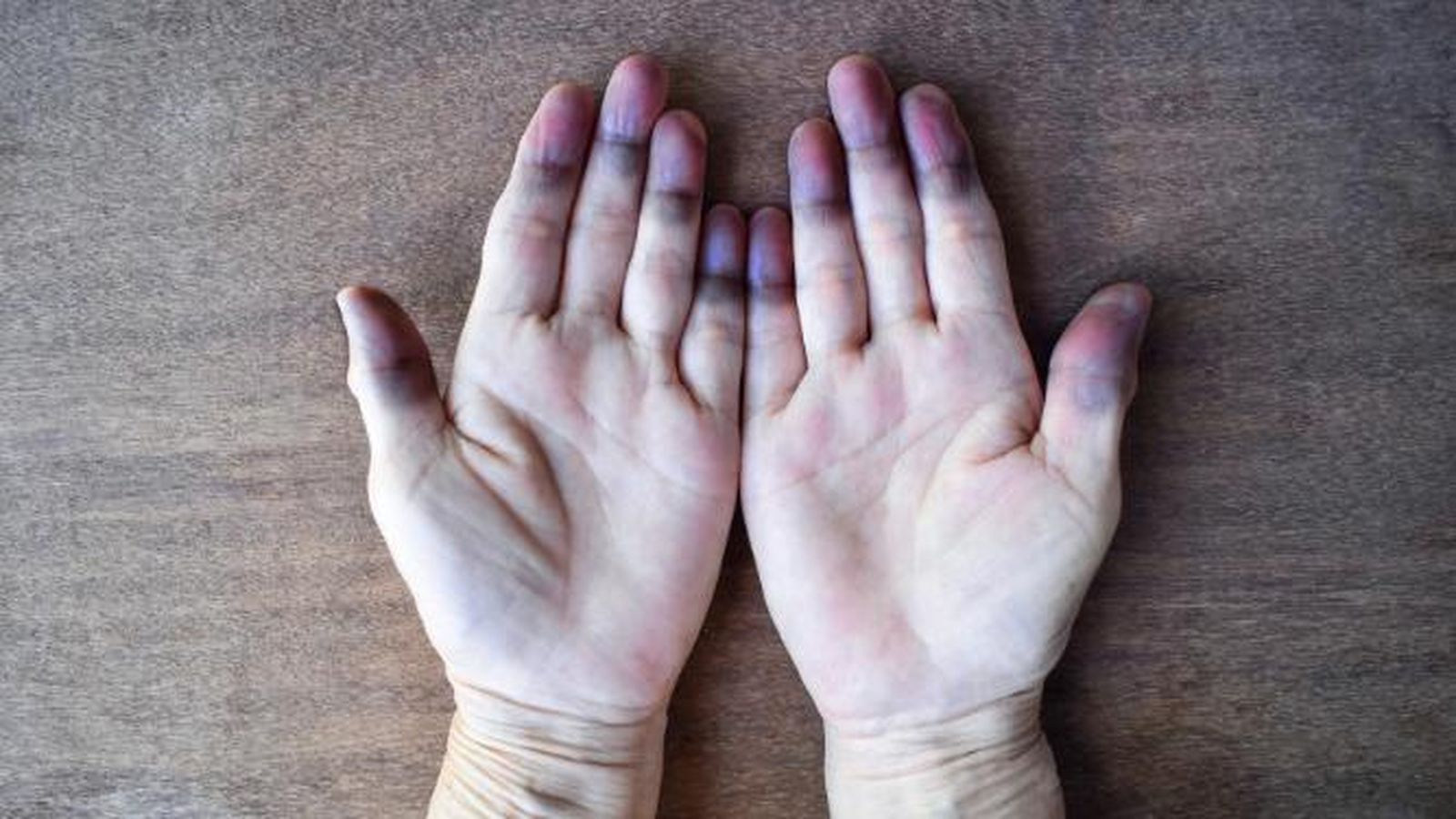 En qué consiste la cianosis, la enfermedad que tanto está dando qué hablar en el caso Yéremi Vargas