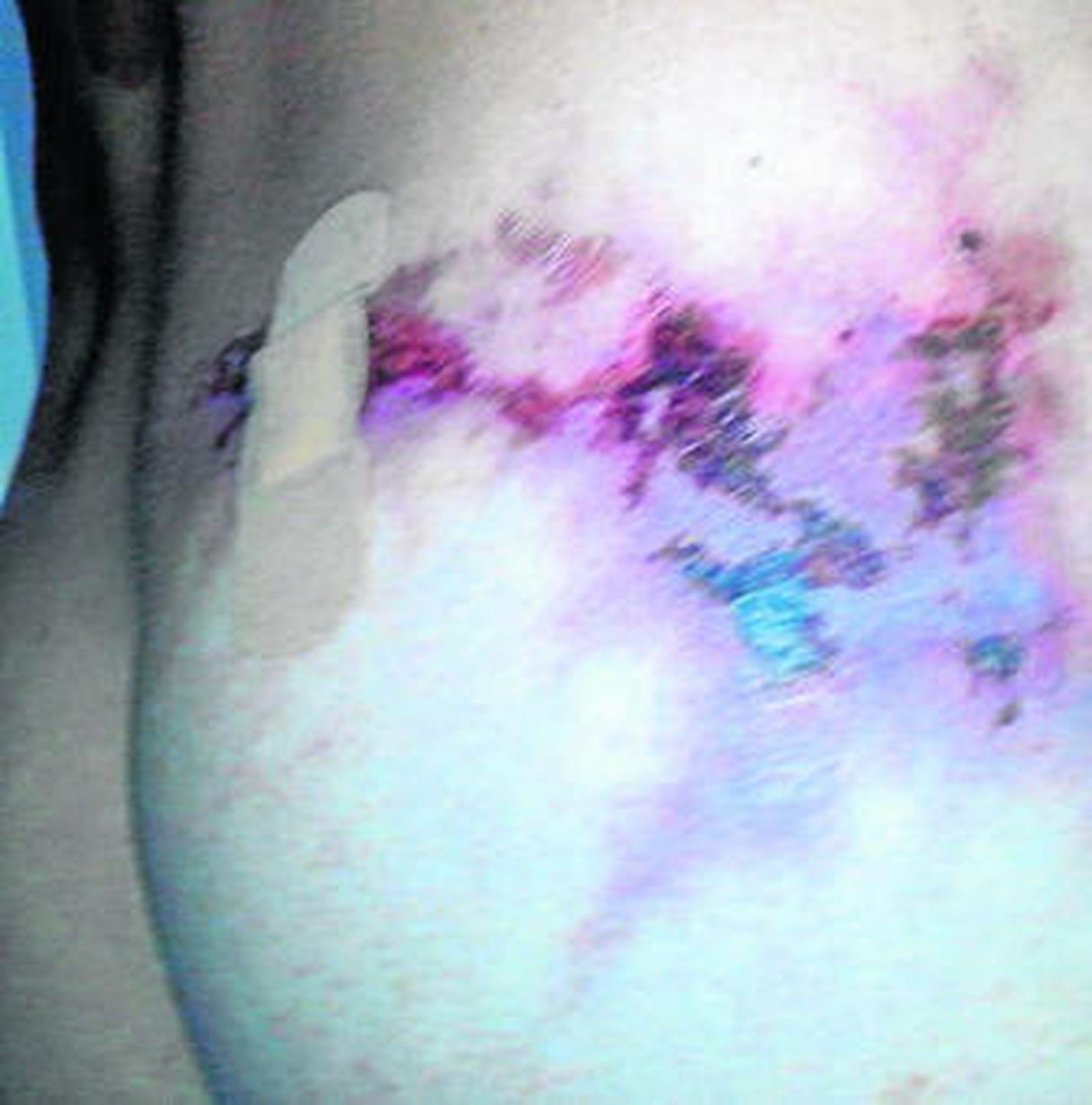 Imagen del glúteo necrosado a mediados de octubre.