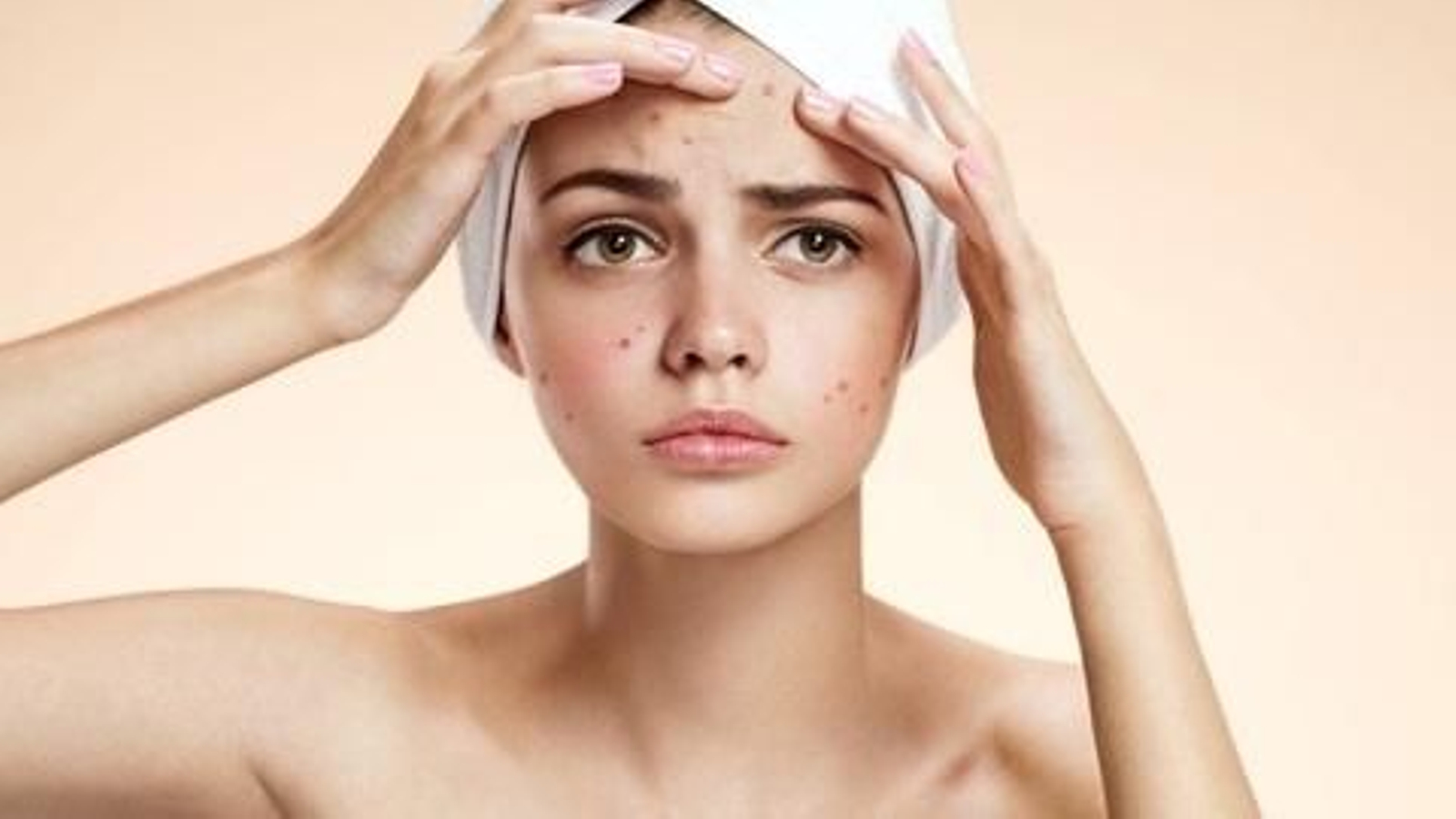 Sol y acné: ¿Es beneficioso para la piel?