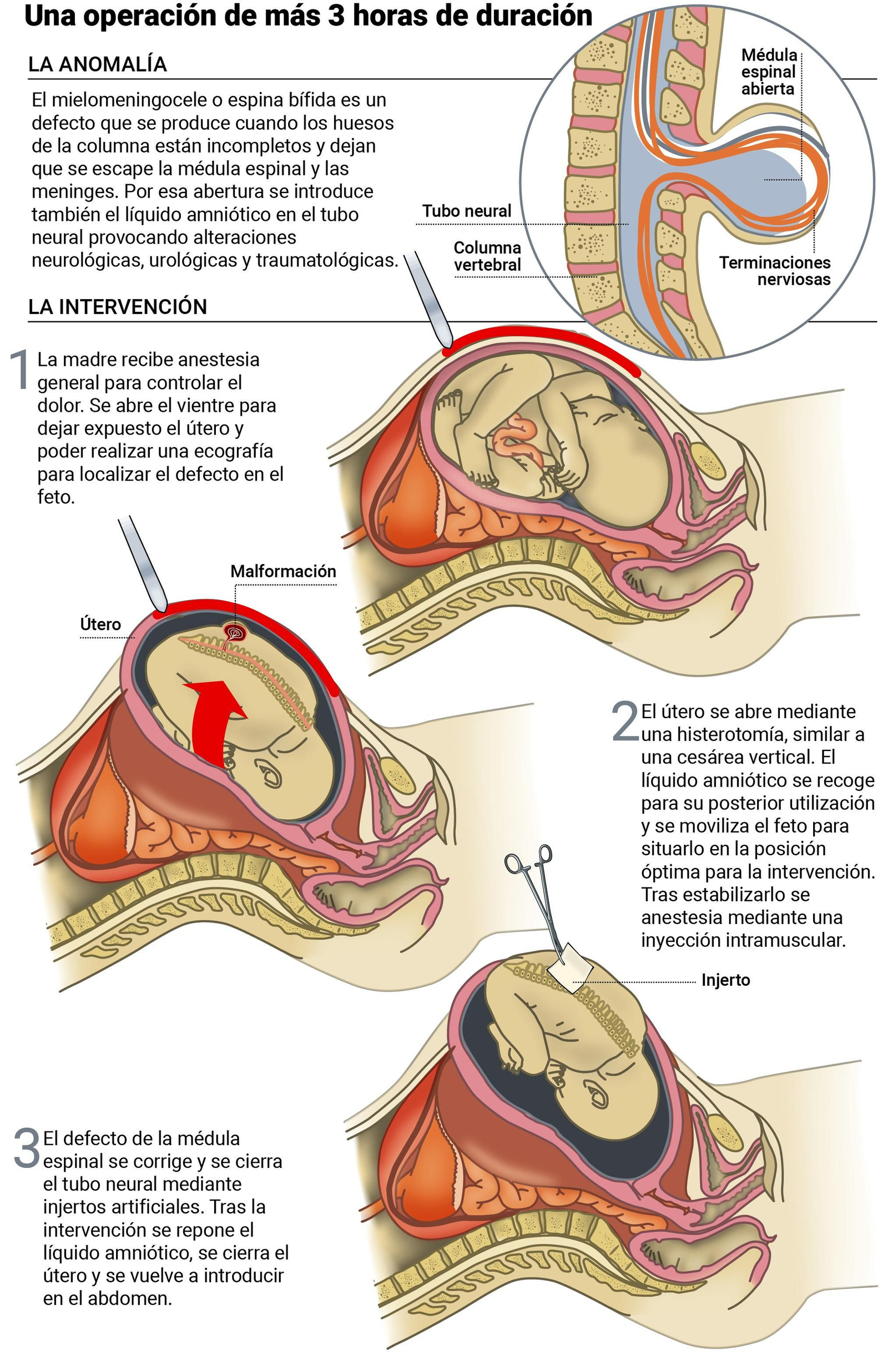 La compleja neurocirugía fetal, paso a paso.