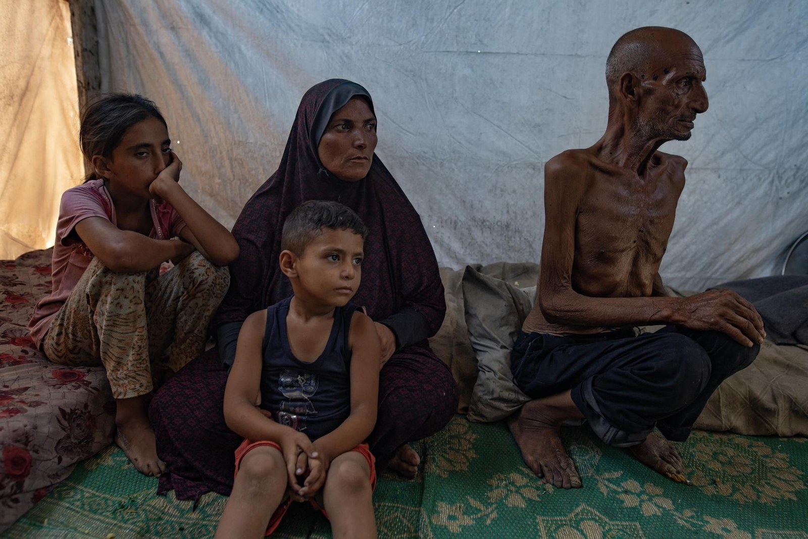 Un adulto palestino, con severa desnutrición.