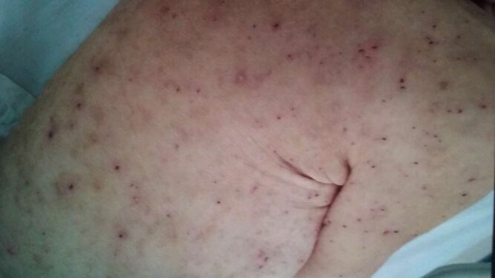 Brazo de uno de los afectados.