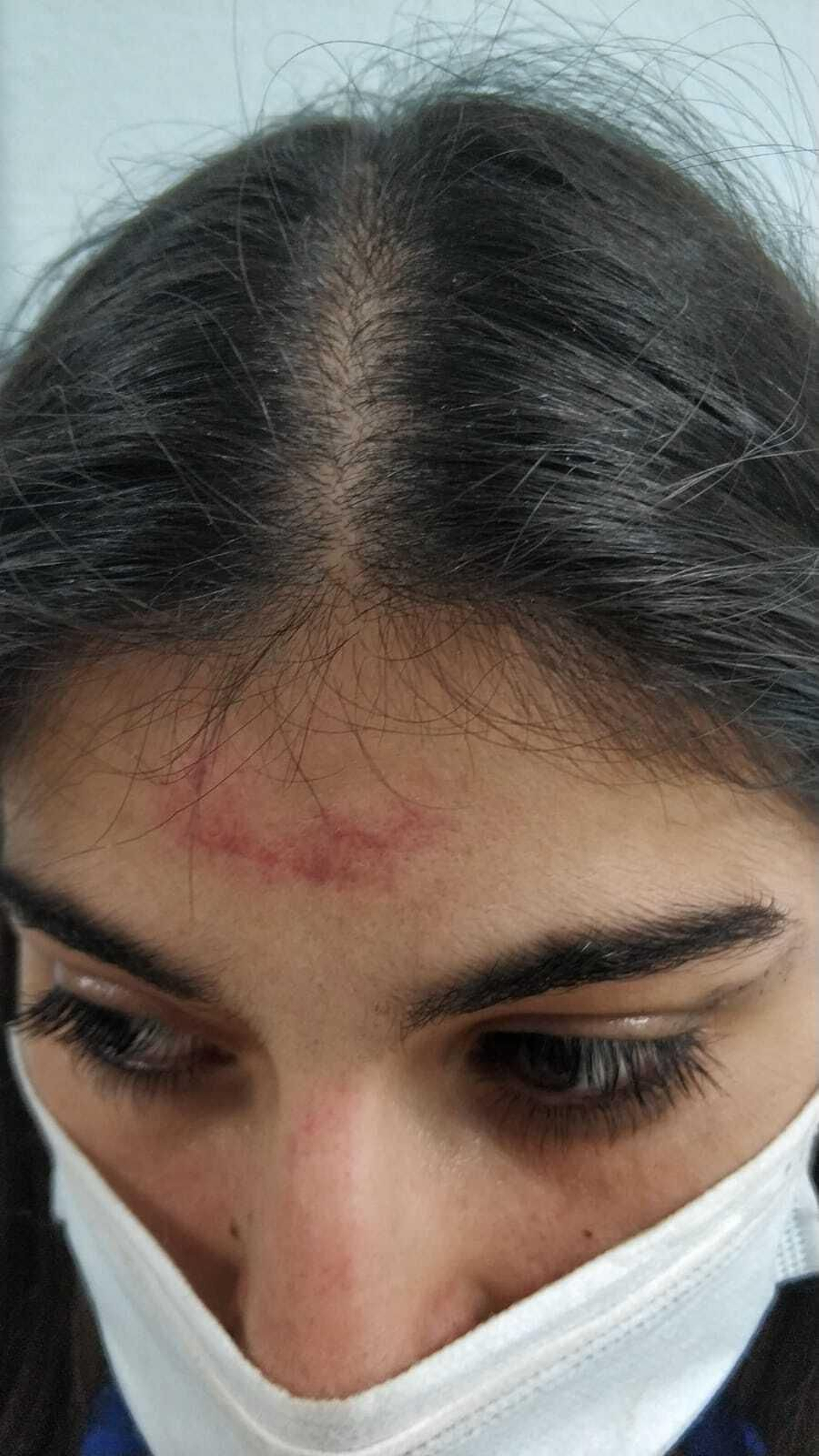 La trabajadora muestra al contusión que sufrió.