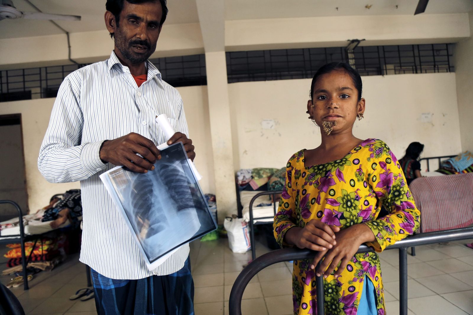 Diagnostican  a una niña la enfermedad del 'hombre árbol'