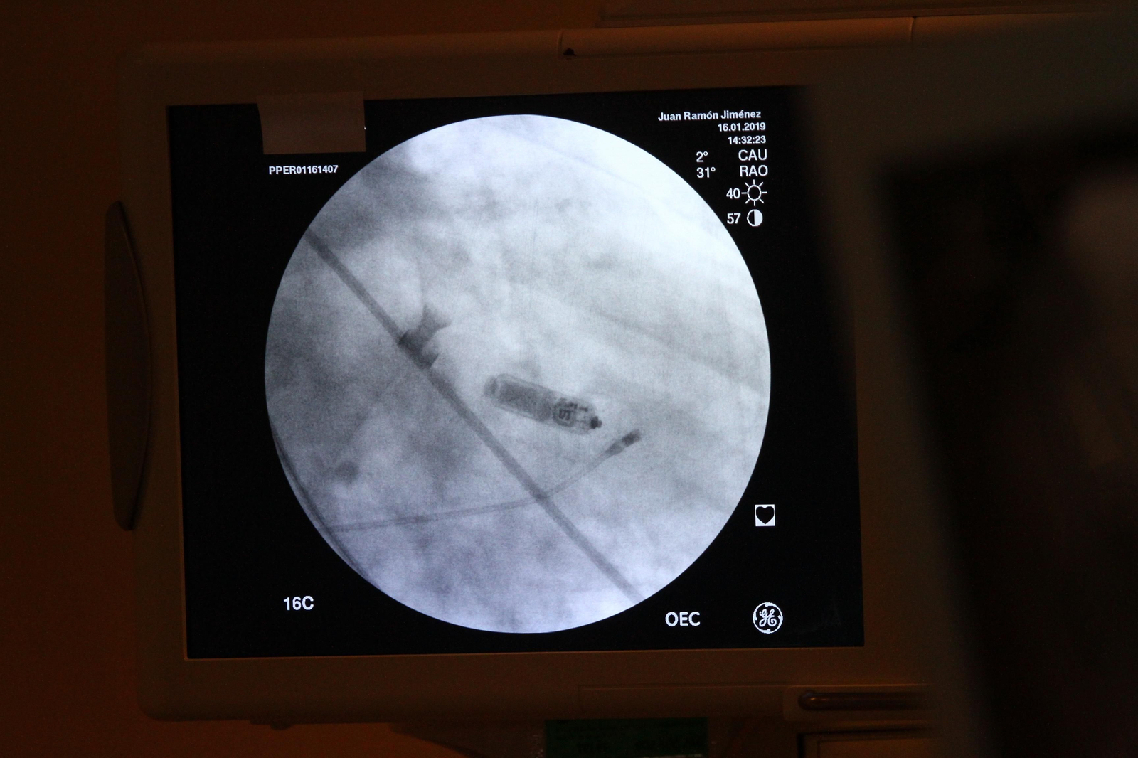 El Hospital Juan Ramón Jiménez implanta los dos primeros marcapasos sin cable en pacientes onubenses