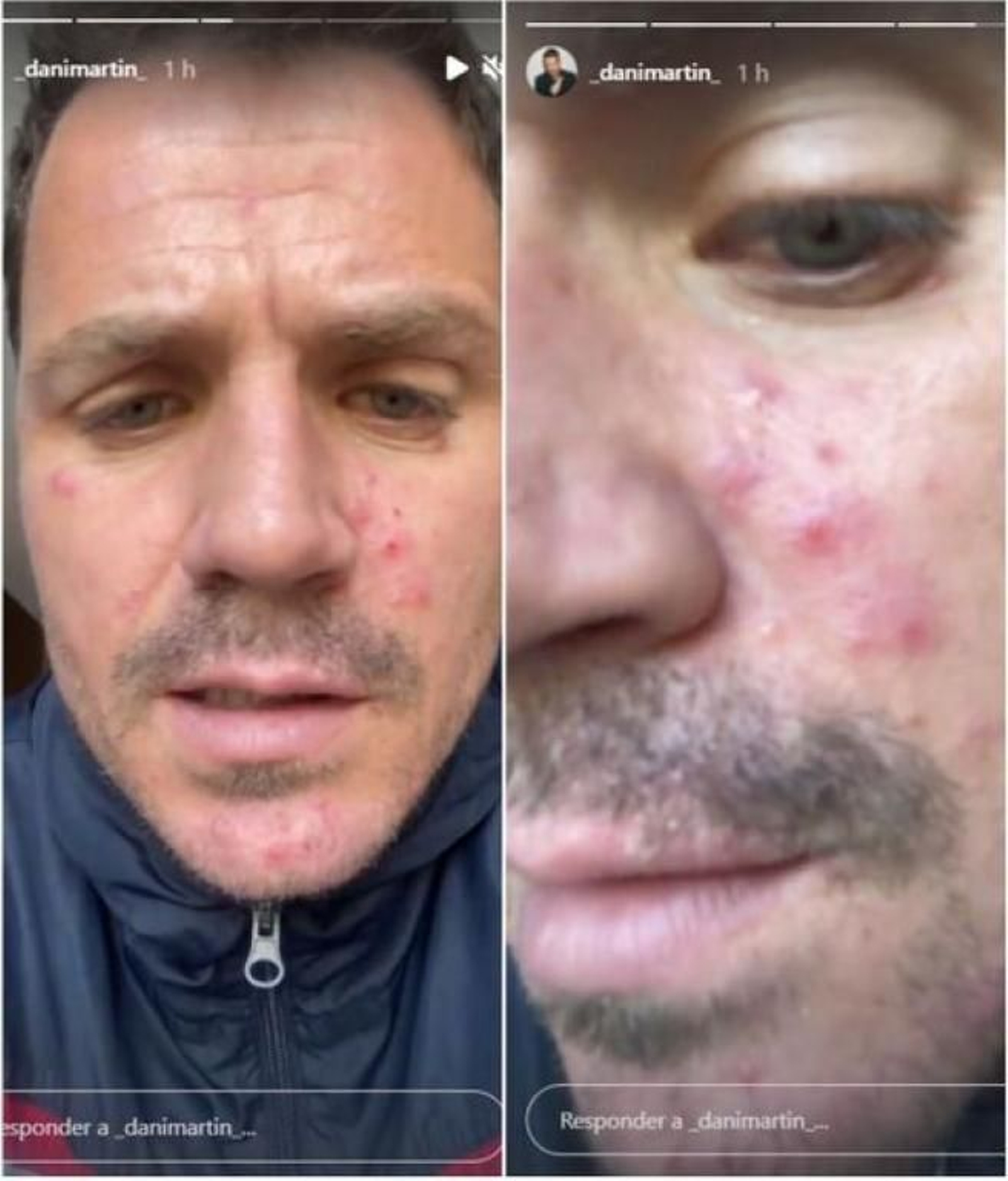 Rosácea Dani Martín Instagram