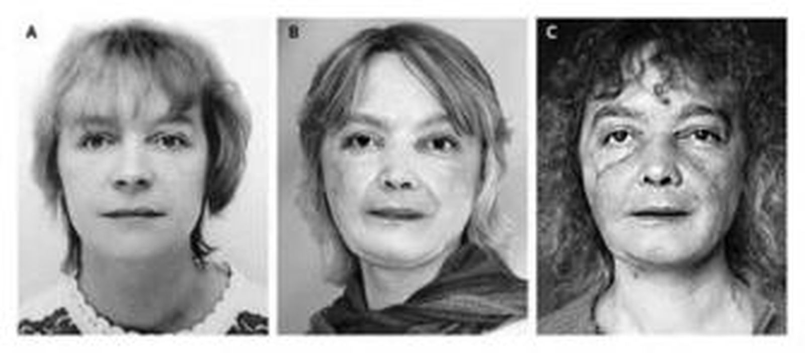 La primera paciente		que recibió un trasplante de cara hace vida normal