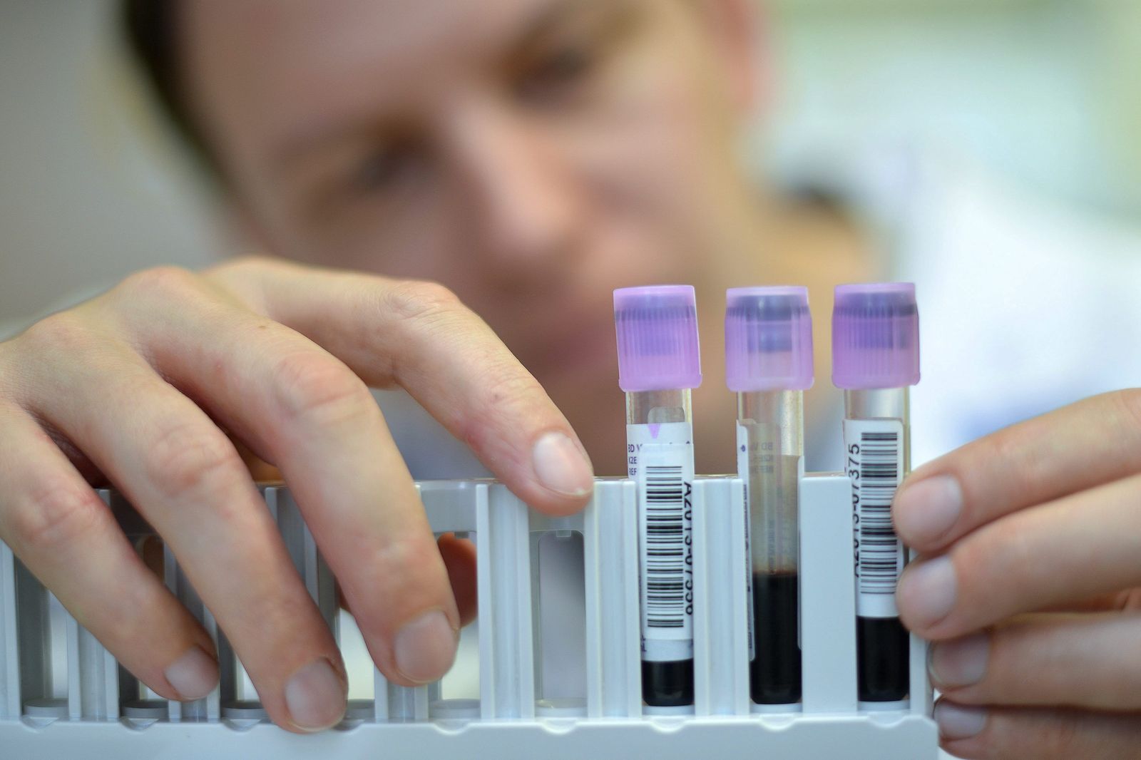 La hepatitis se diagnostica a través de un análisis de sangre.