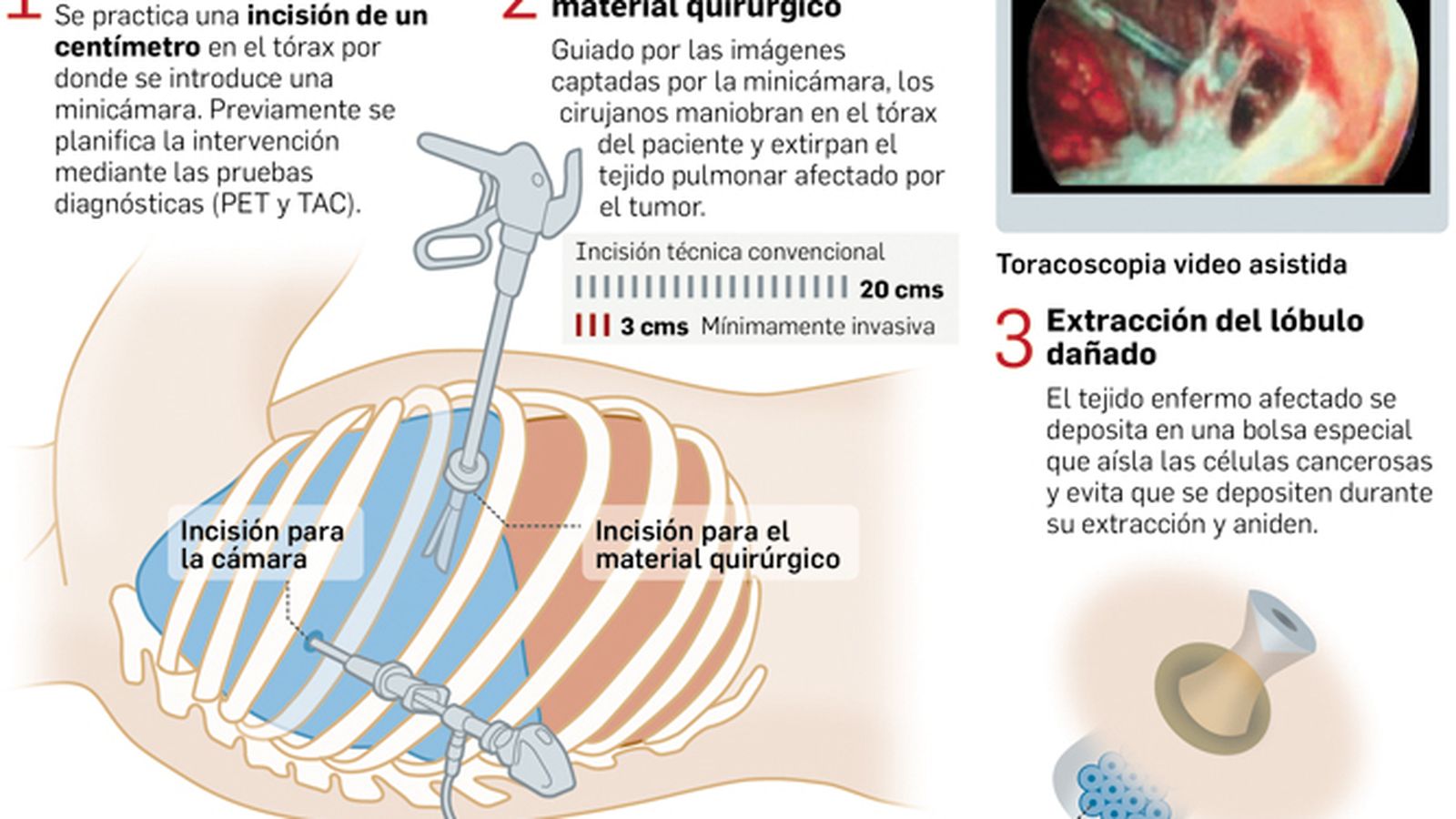 Operacion cancer de pulmon