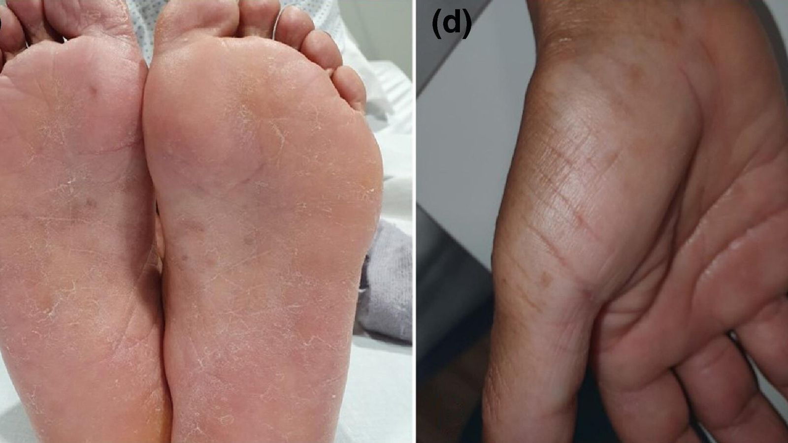 Pies y manos, también con afecciones.