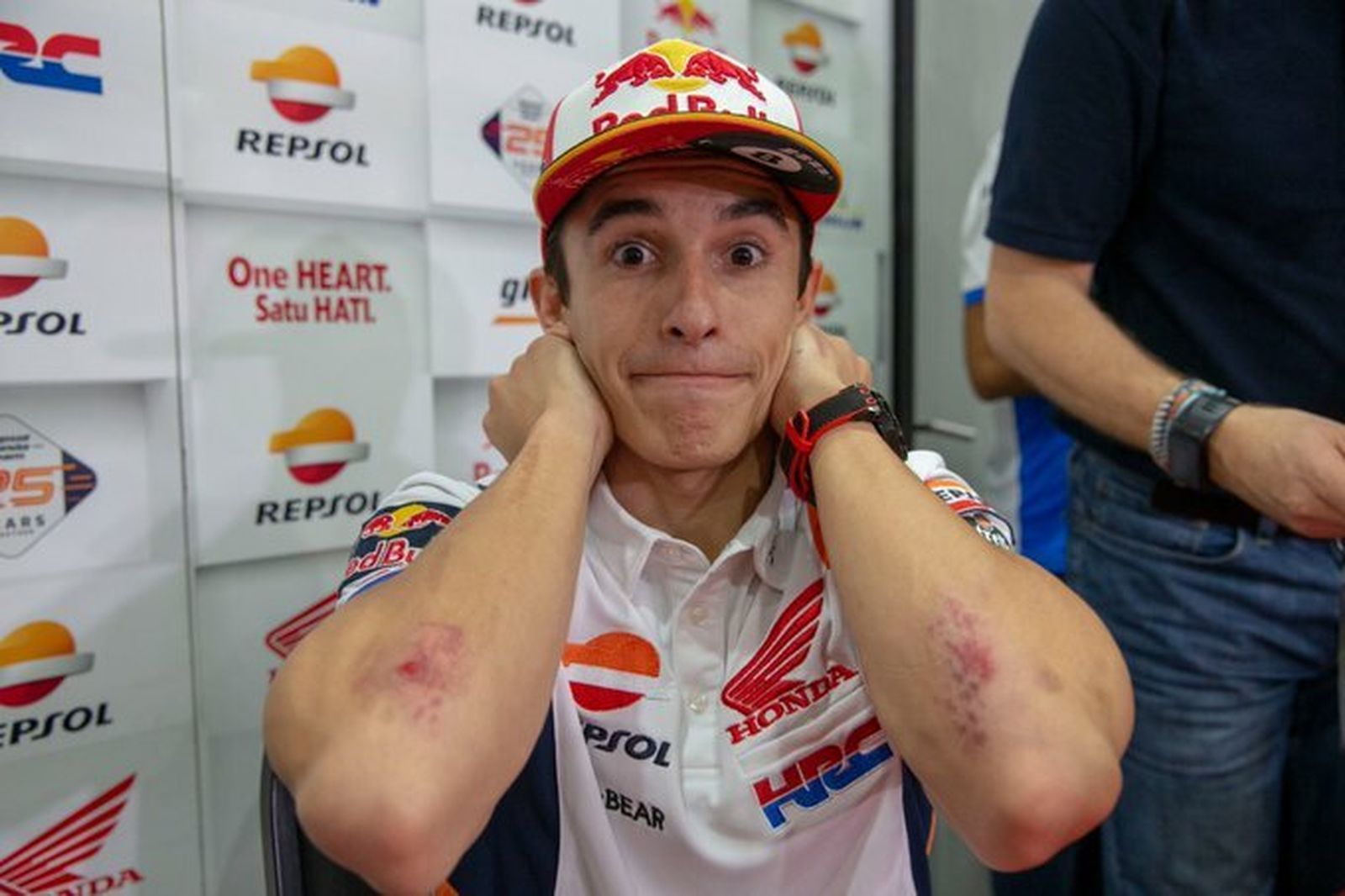 Marc Márquez enseña los antebrazos tras su aparatosa caída en Sepang.