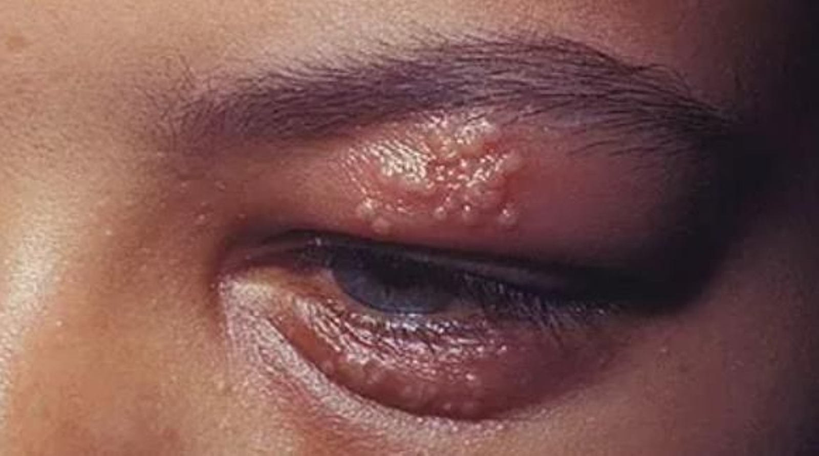 Herpes en los ojos: La incómoda y peligrosa afección relacionada con el estrés