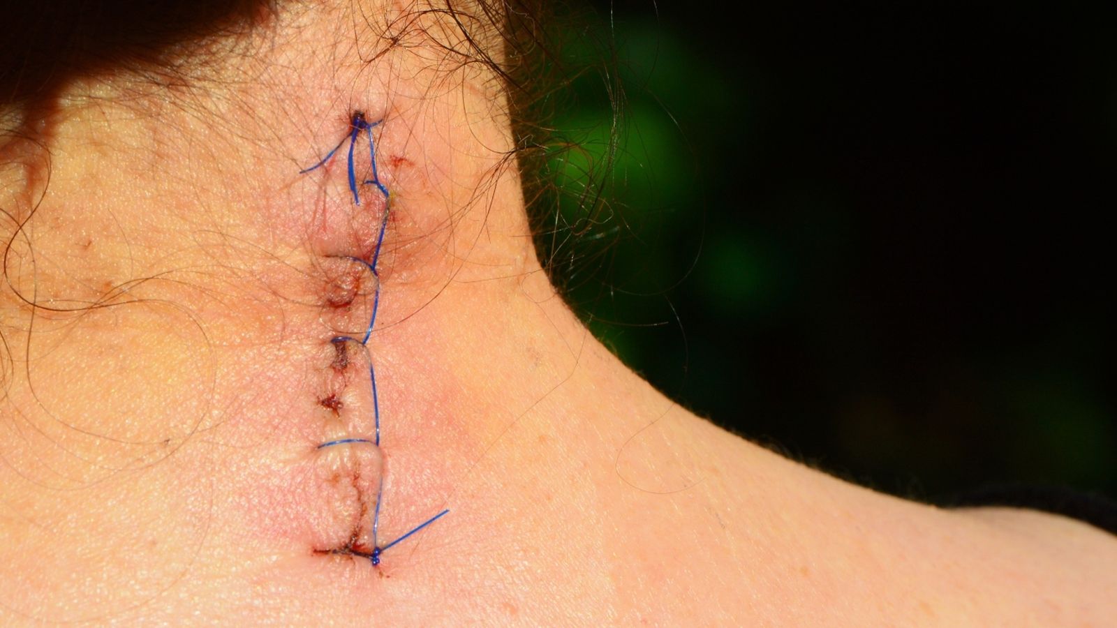 Una cicratiz en la zona del cuello.