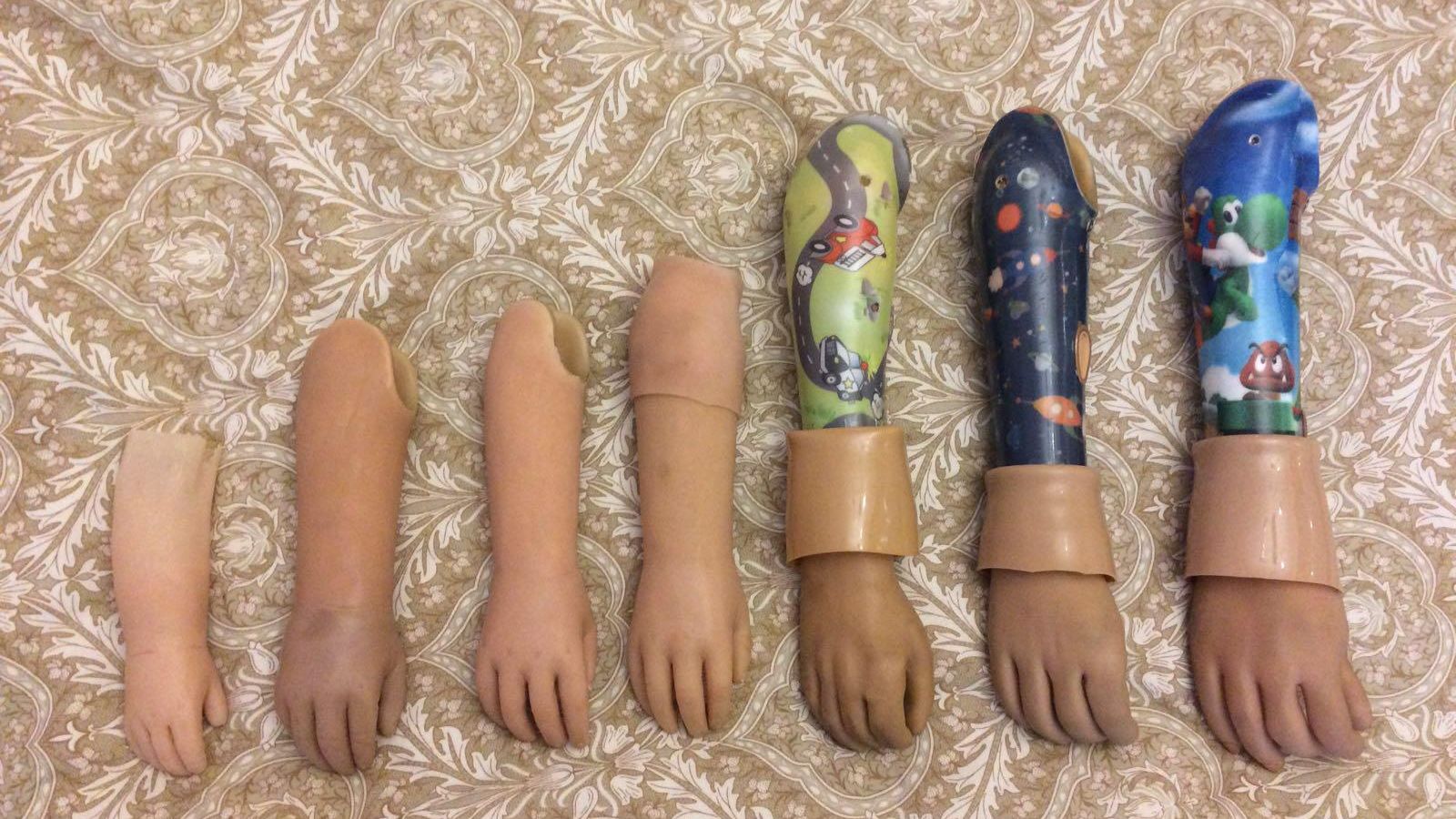 Todas las prótesis que ha tenido Martín.