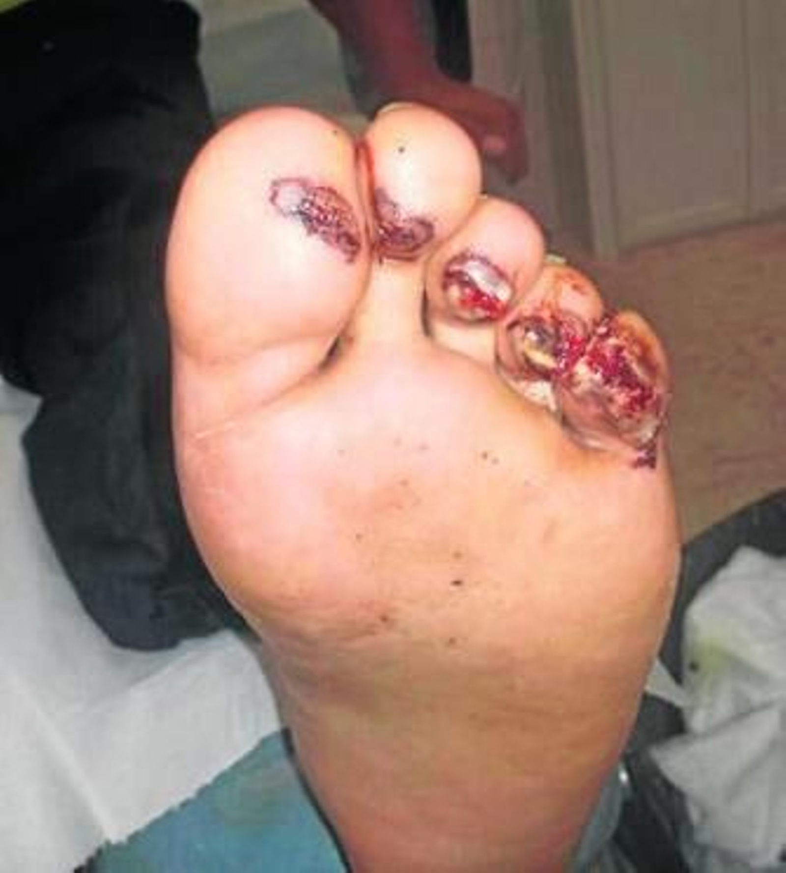 Las heridas que la bala causó en el pie a la víctima tras el tiroteo.