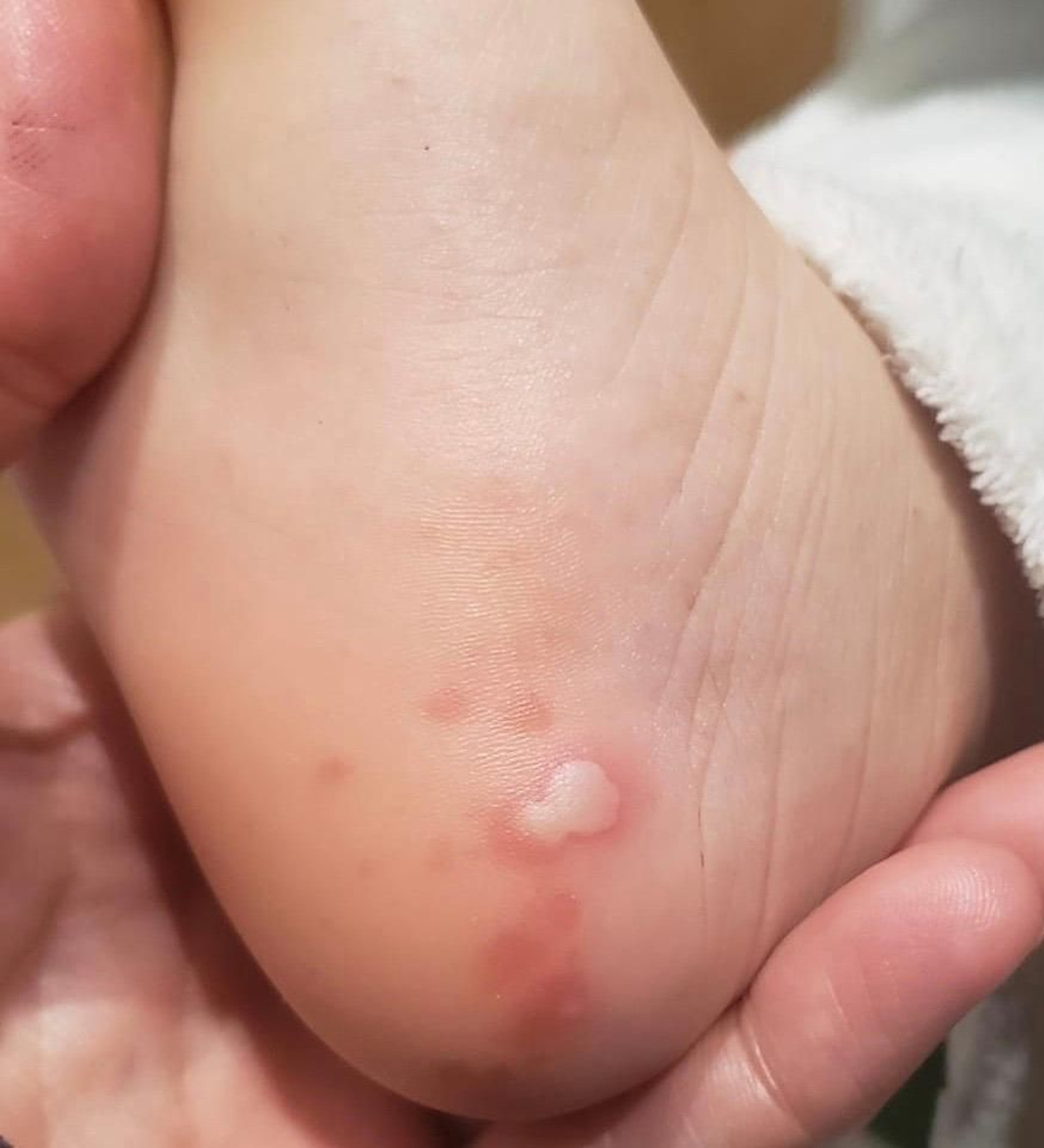 Una de las imágenes del estudio de dermatología sobre efectos en la piel de pacientes con Covid o sospechosos