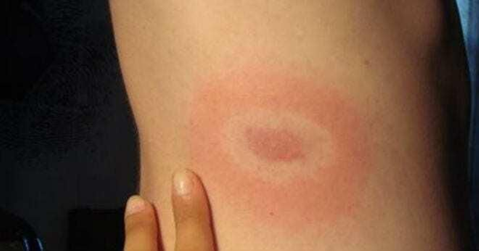 Las garrapatas pueden transmitir numerosas infecciones con su picadura.