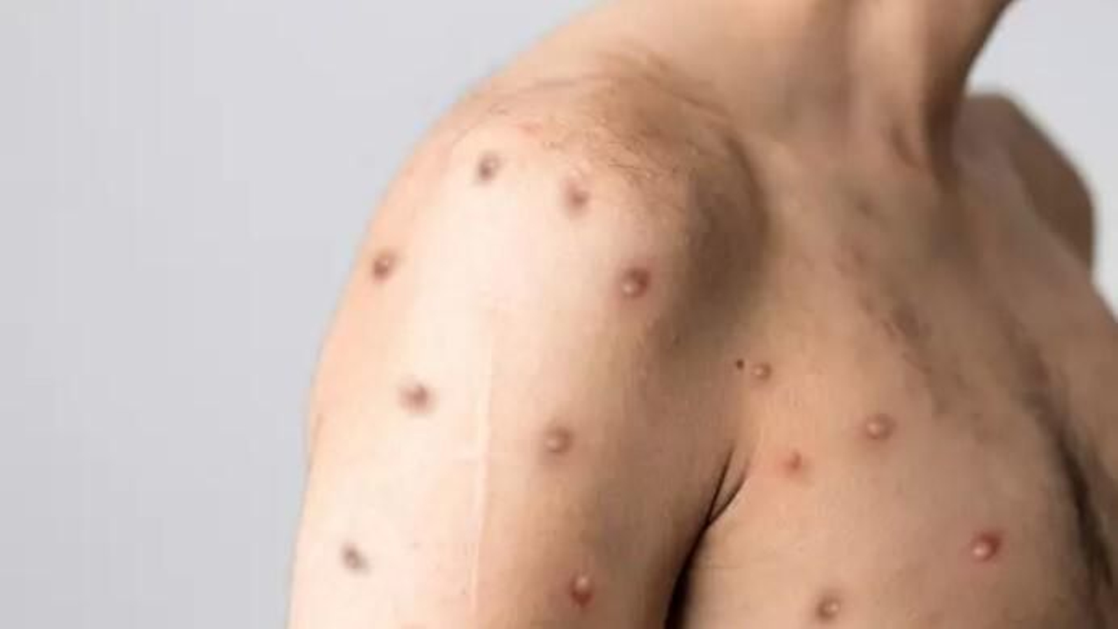 Un hombre con la viruela del mono