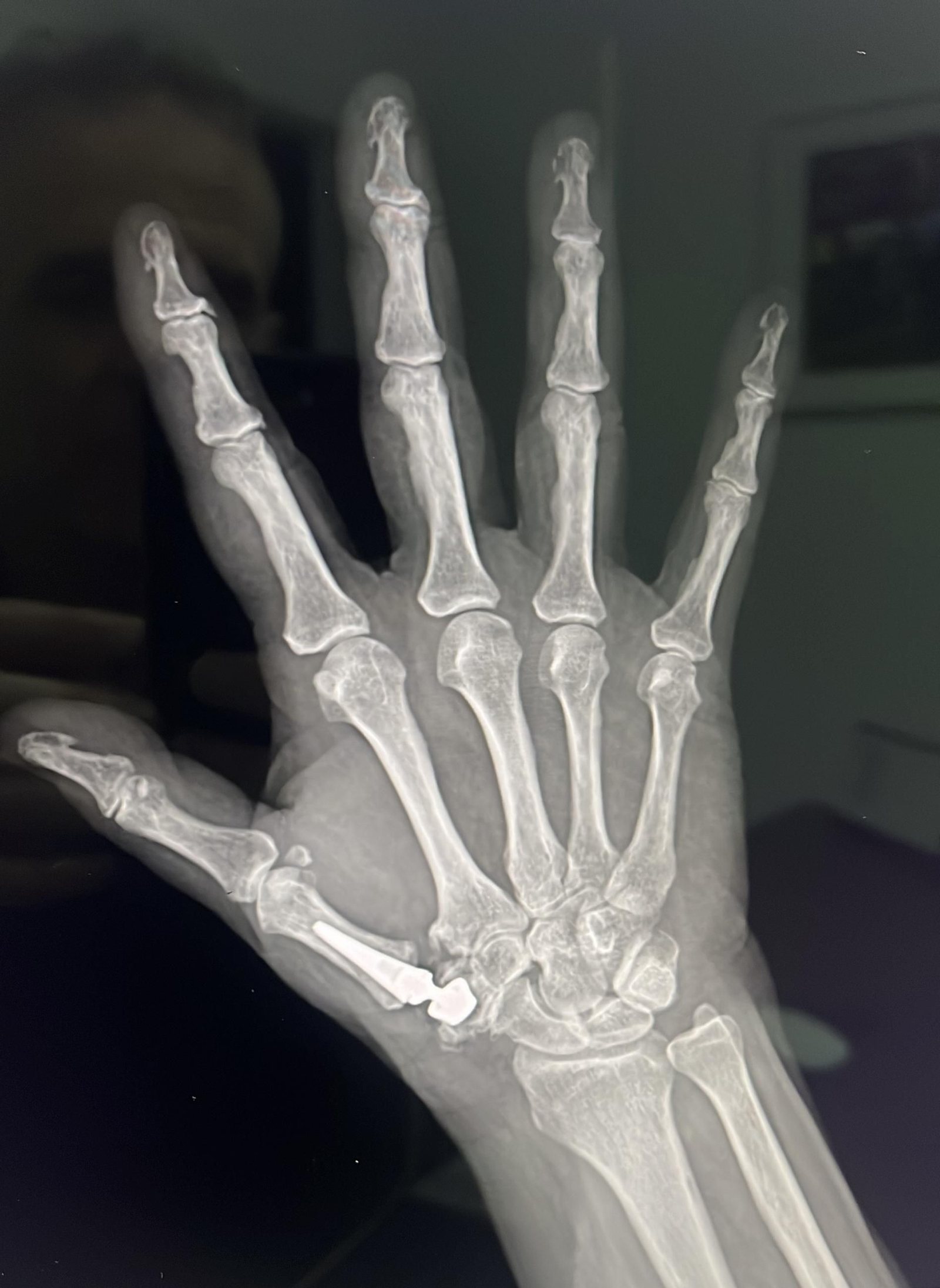 Radiografía en la que se observa la implantación de una prótesis trapeciometacarpiana como la que se ha tenido que usar con Rafa Nadal.