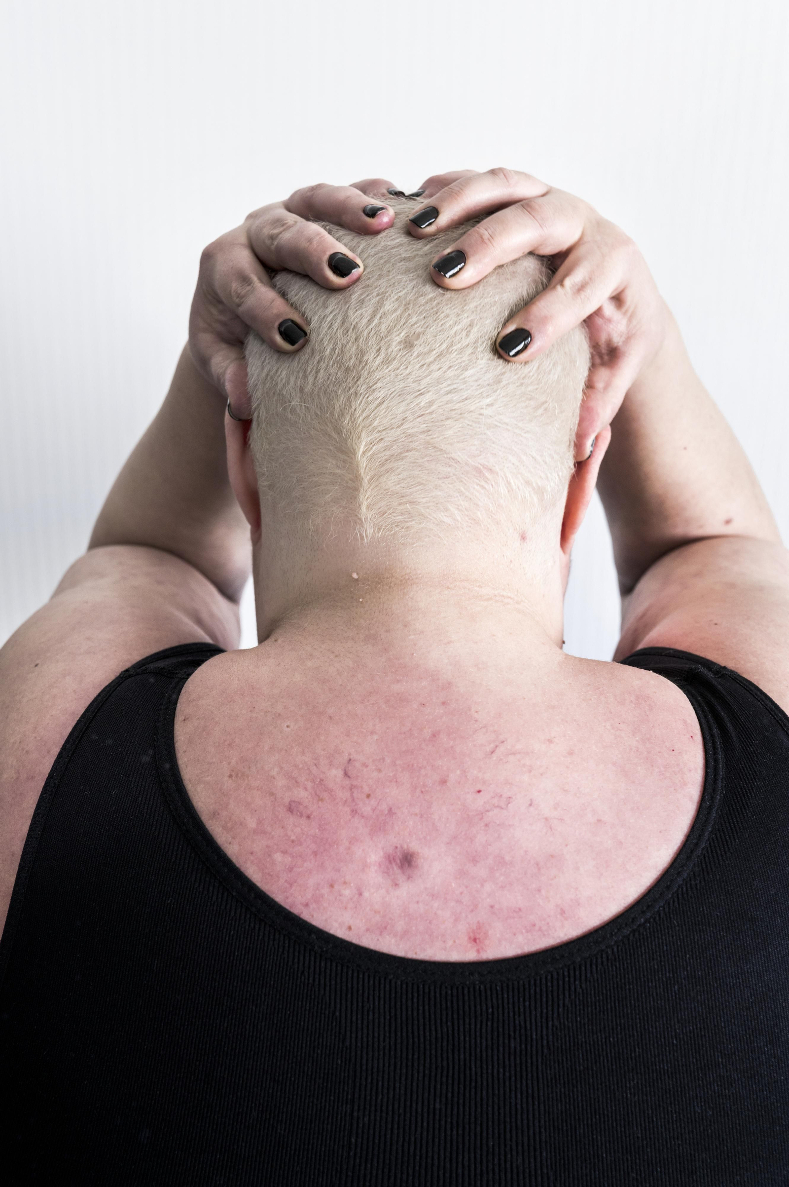 Silvia, otra de las afectadas por el lupus fotografiada por Ana Nance. Silvia, otra de las afectadas por el lupus fotografiada por Ana Nance.