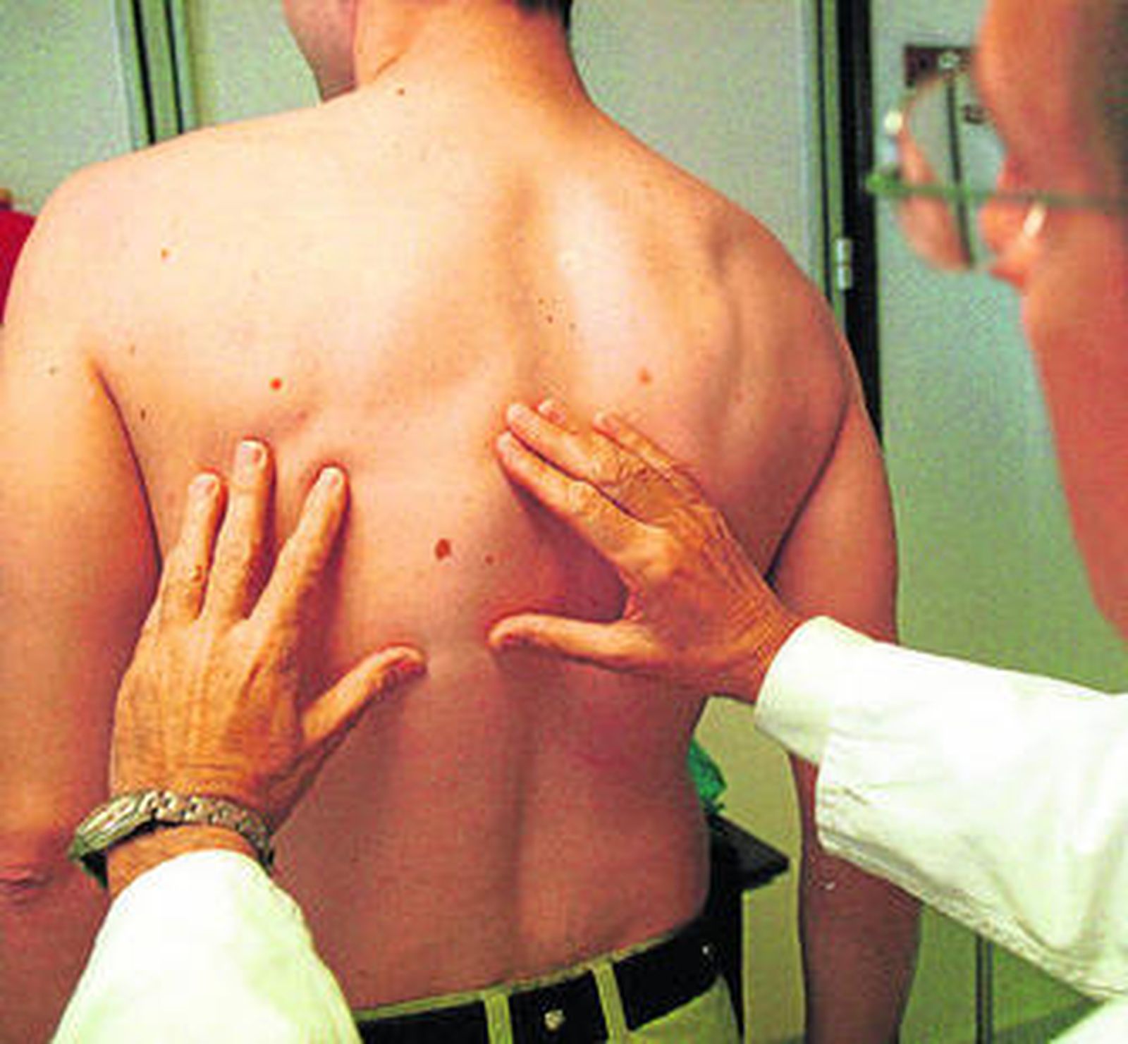 Un especialista examina un lunar de un hombre para ver si se trata de un melanoma.