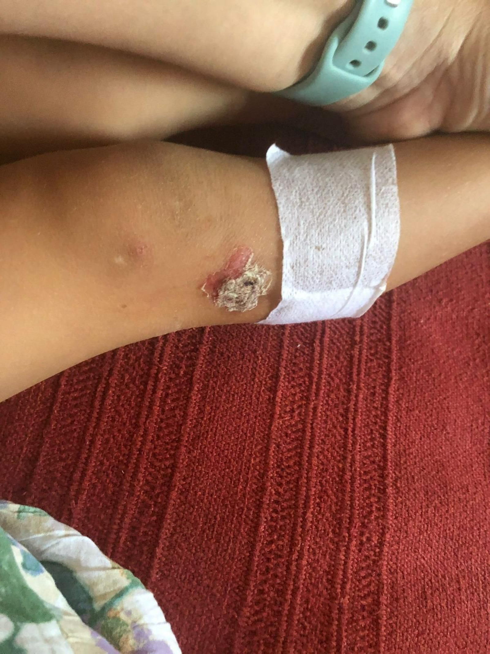 Estado de las heridas provocadas por la plaga de pulgas en uno de los menores afectados.