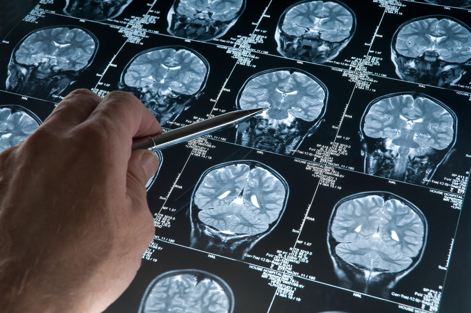 El glioblastoma es el tumor cerebral primario más agresivo y de peor pronóstico. El glioblastoma es el tumor cerebral primario más agresivo y de peor pronóstico.