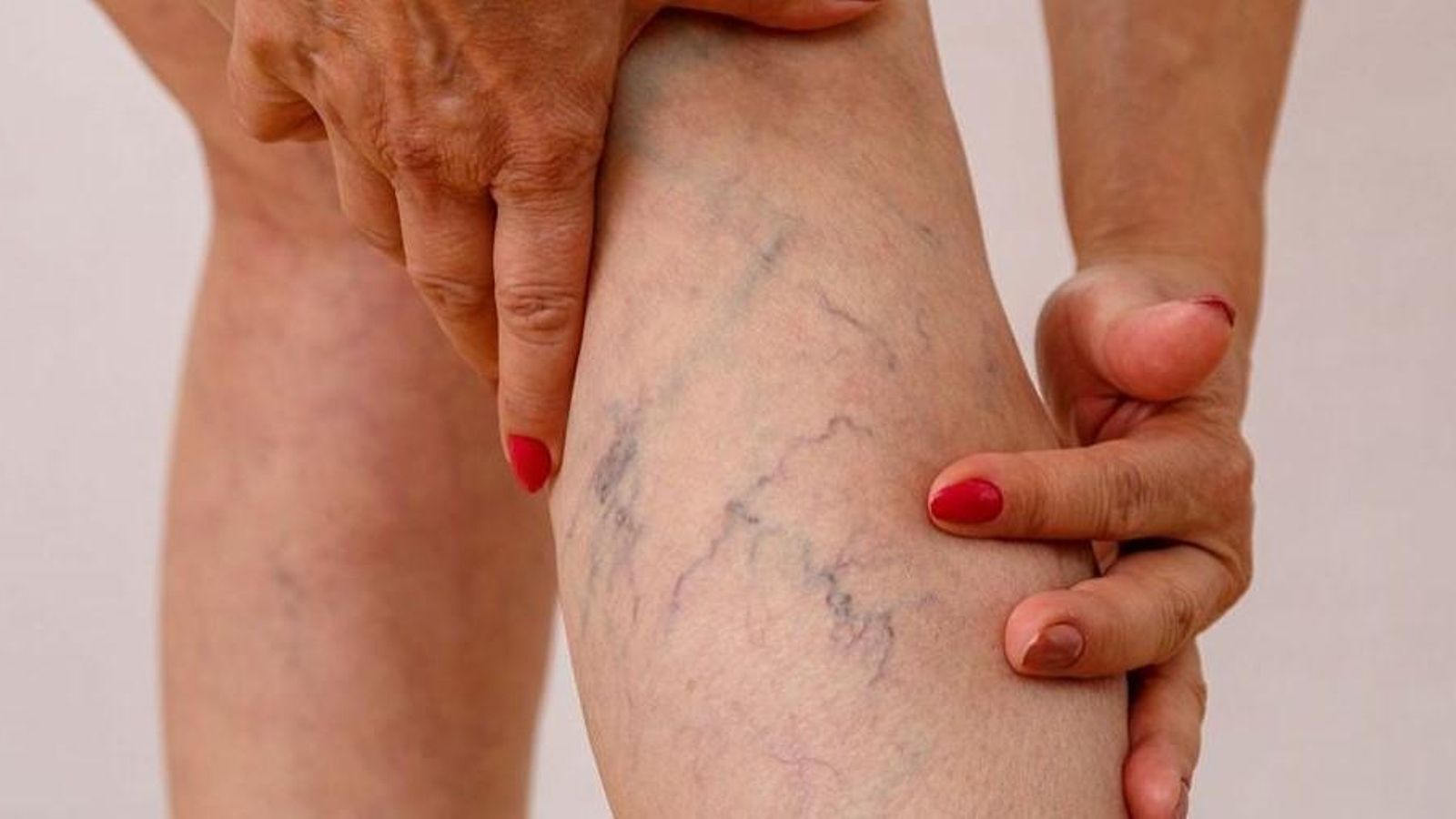 Varices, un problema circulatorio con un amplio abanico para solucionarlo