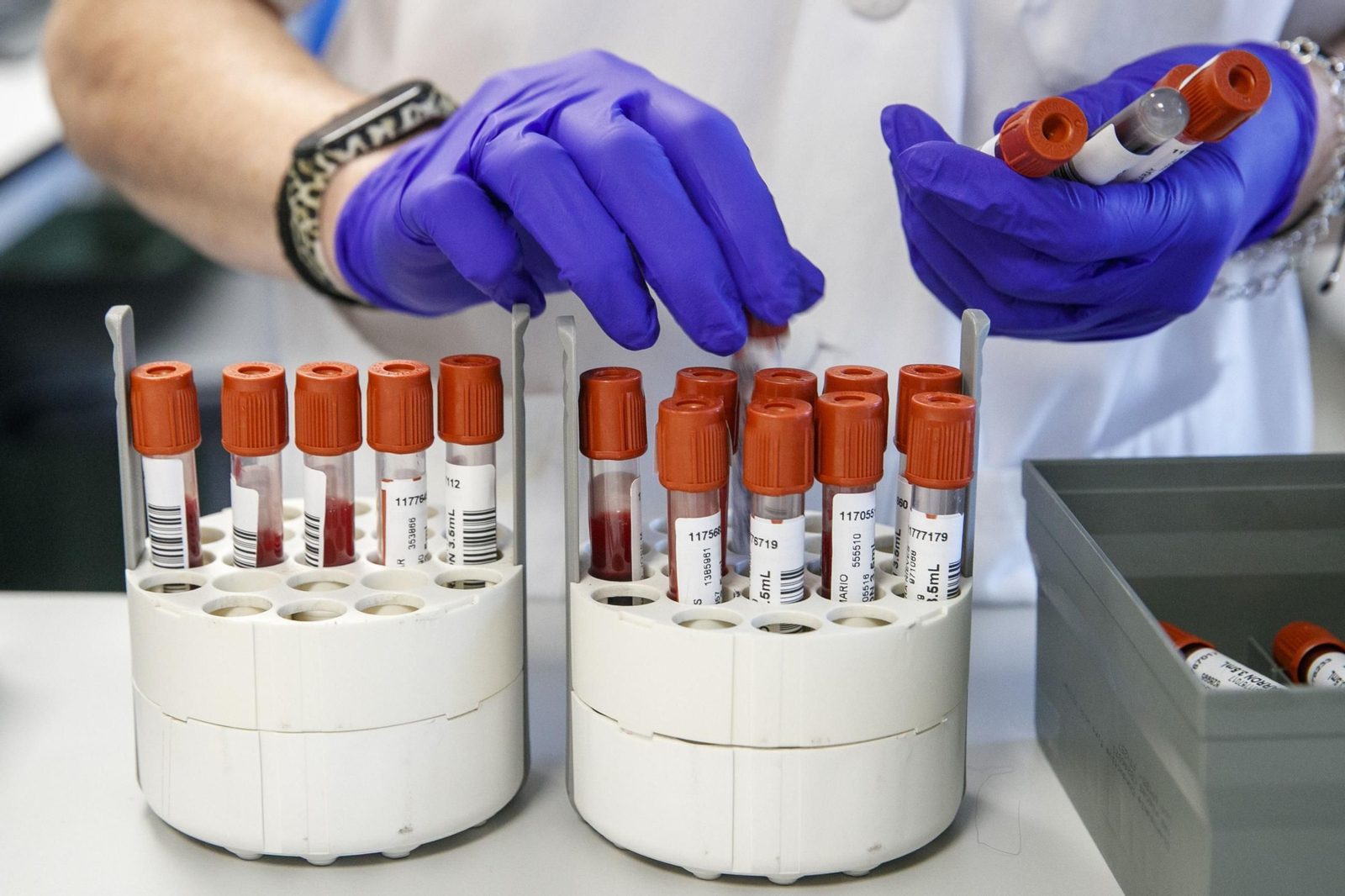 España, a falta de un impulso final para ser el primer país en eliminar la hepatitis C