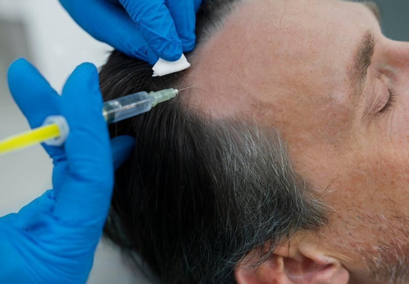 Injerto capilar en España o Turquía, ¿qué es mejor?