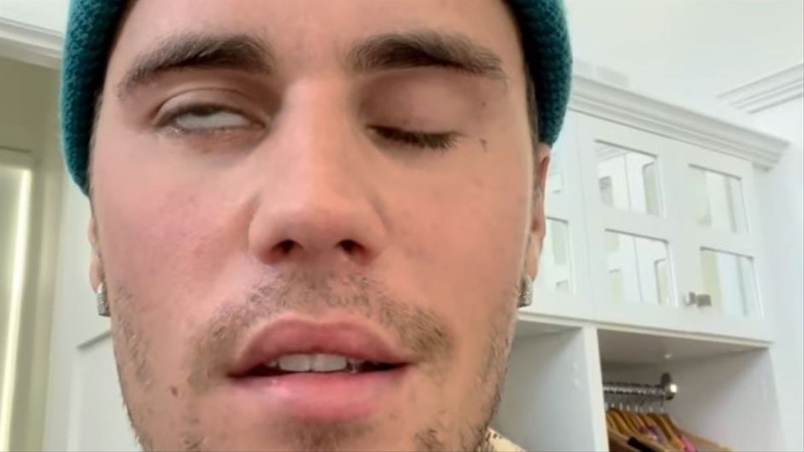 Las causas del Síndrome de Ramsay Hunt, el desencadenante de la parálisis facial de Justin Bieber