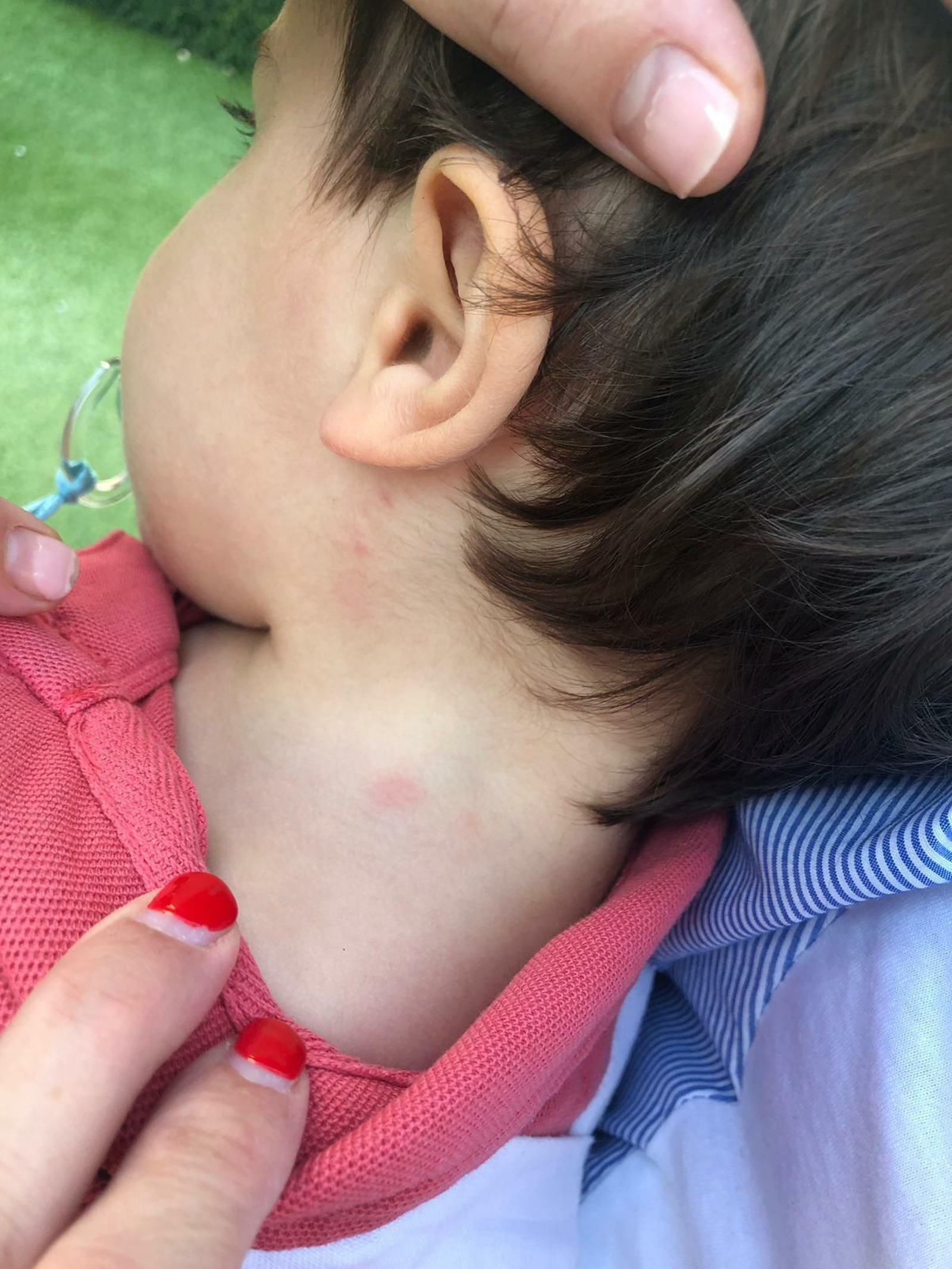 Algunas picaduras que presentaba un niño de la urbanización. Algunas picaduras que presentaba un niño de la urbanización.