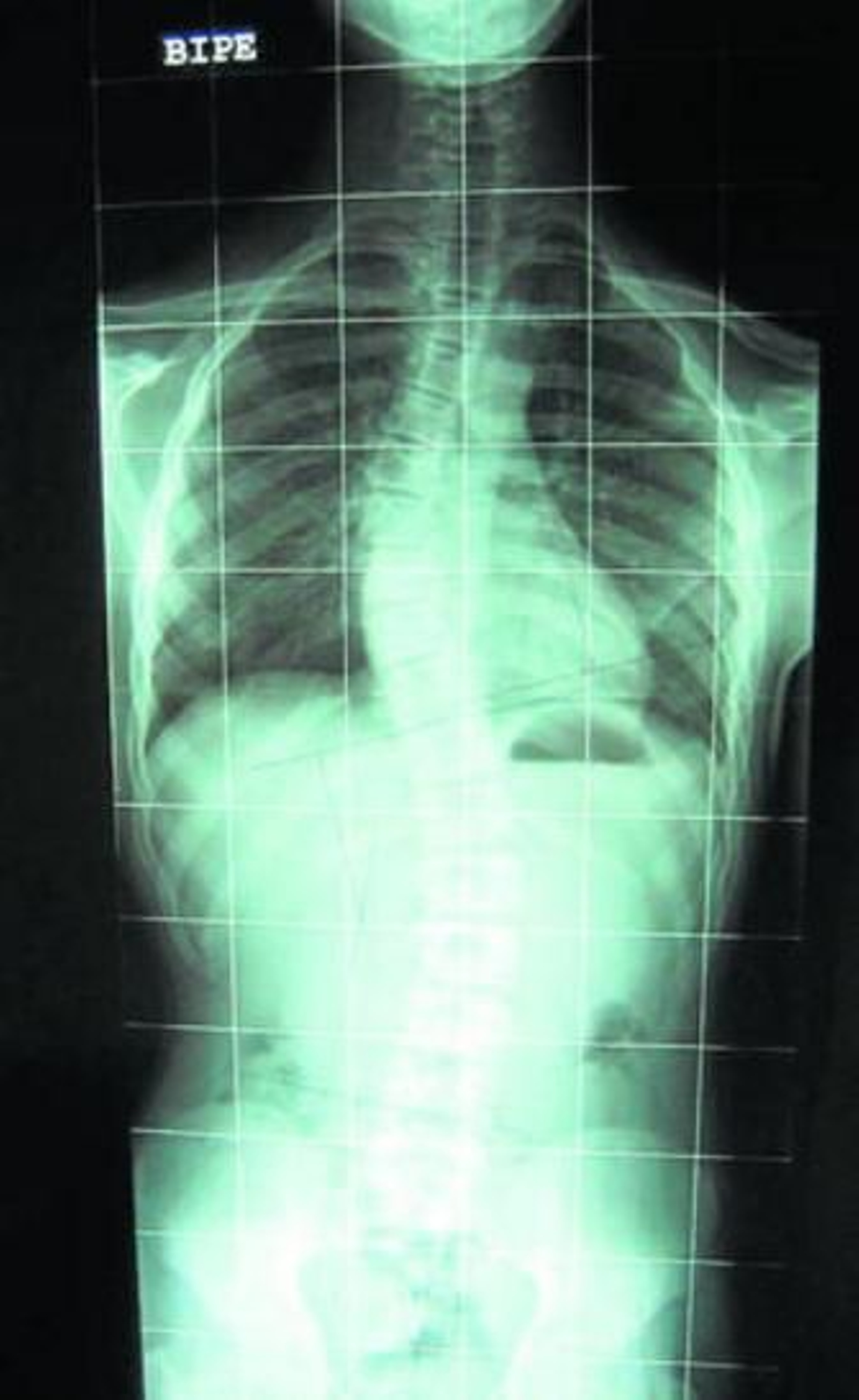 ¿Qué es la escoliosis?