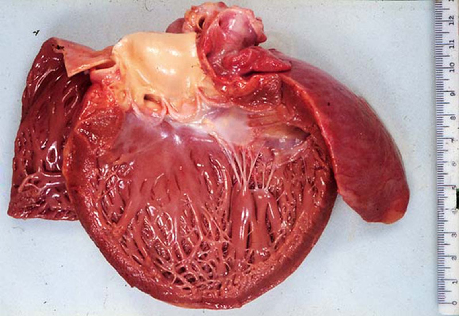 El 20% de las 40.000 muertes súbitas sufridas España se debe a enfermedades hereditarias